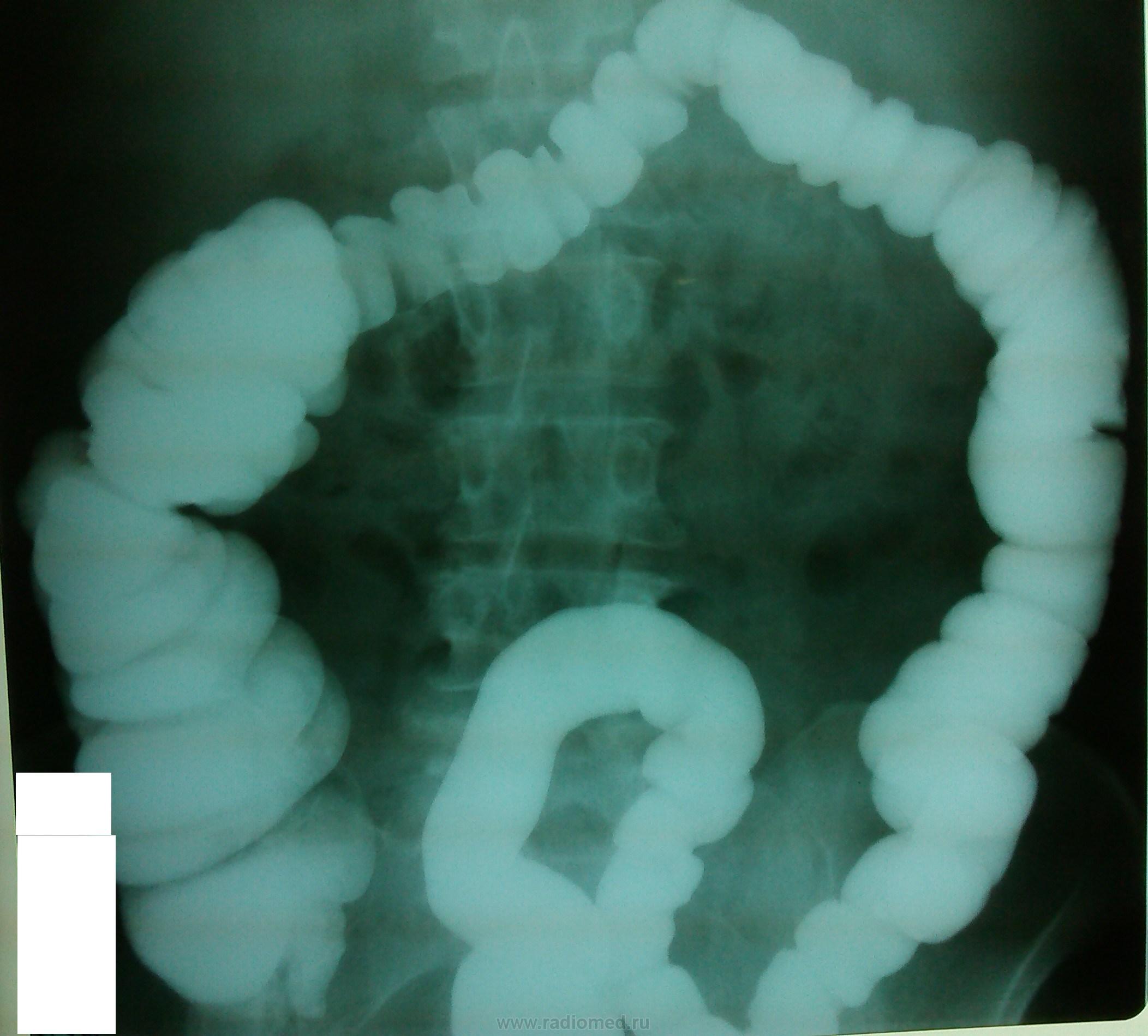 Расширение петель кишечника. Долихосигма ирригоскопия. Ирригография кишечника долихосигма. Ирригоскопия кишечника долихосигма. Долихосигма кишечника рентген.