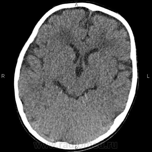 Лейкоареоз головного мозга. Лейкоареоз головного мозга кт. Перивентрикулярный лейкоареоз мрт. Лейкоареоз головного мозга симптомы на кт. Перивентрикулярный лейкоареоз на кт.