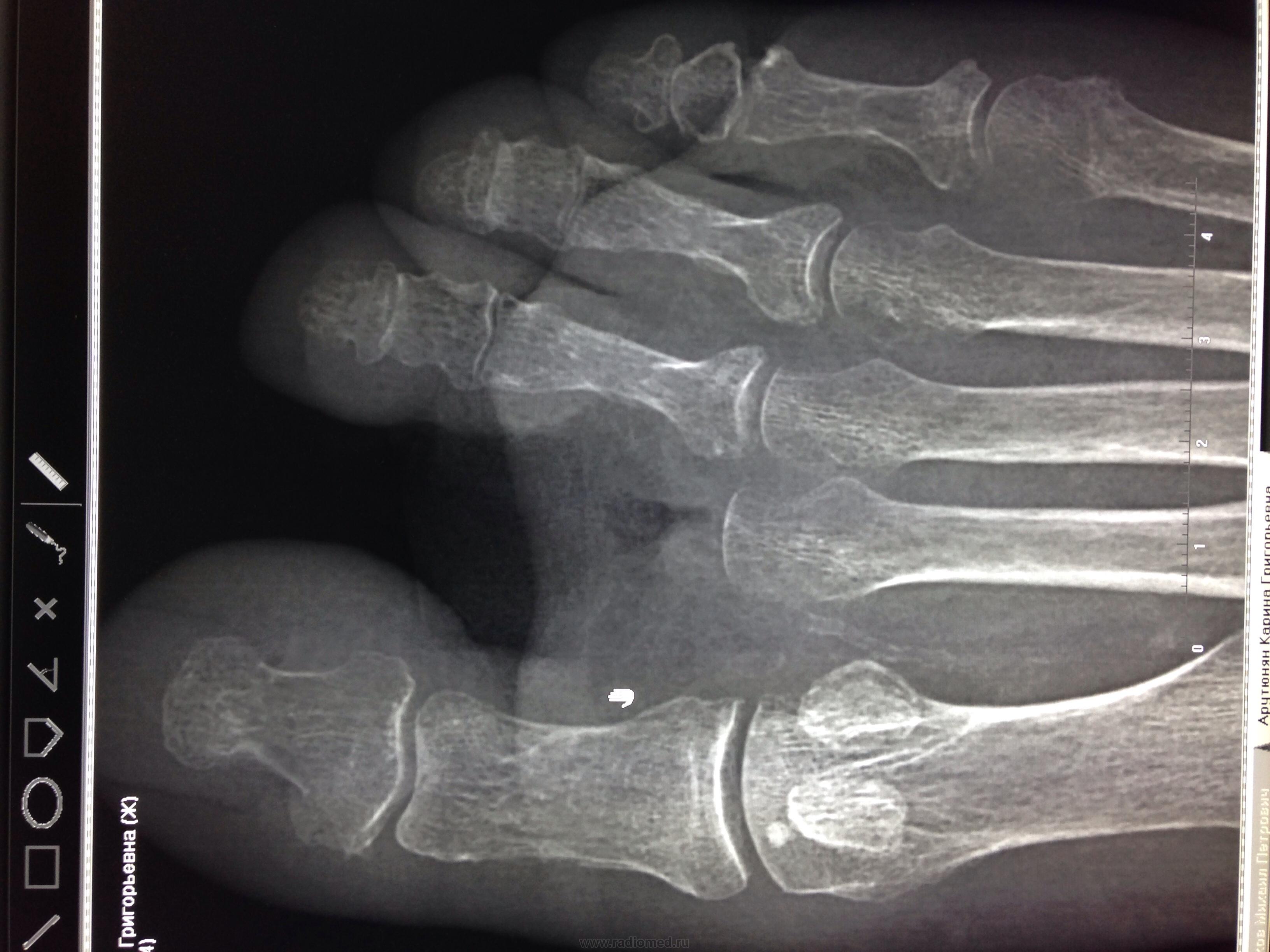 Ногтевой фаланги пальца ноги. Краевой перелом фаланги рентген. Перелом основной фаланги 5 пальца ноги рентген. Краевой перелом ногтевой фаланги. Эпифизеолиз фаланги пальца.