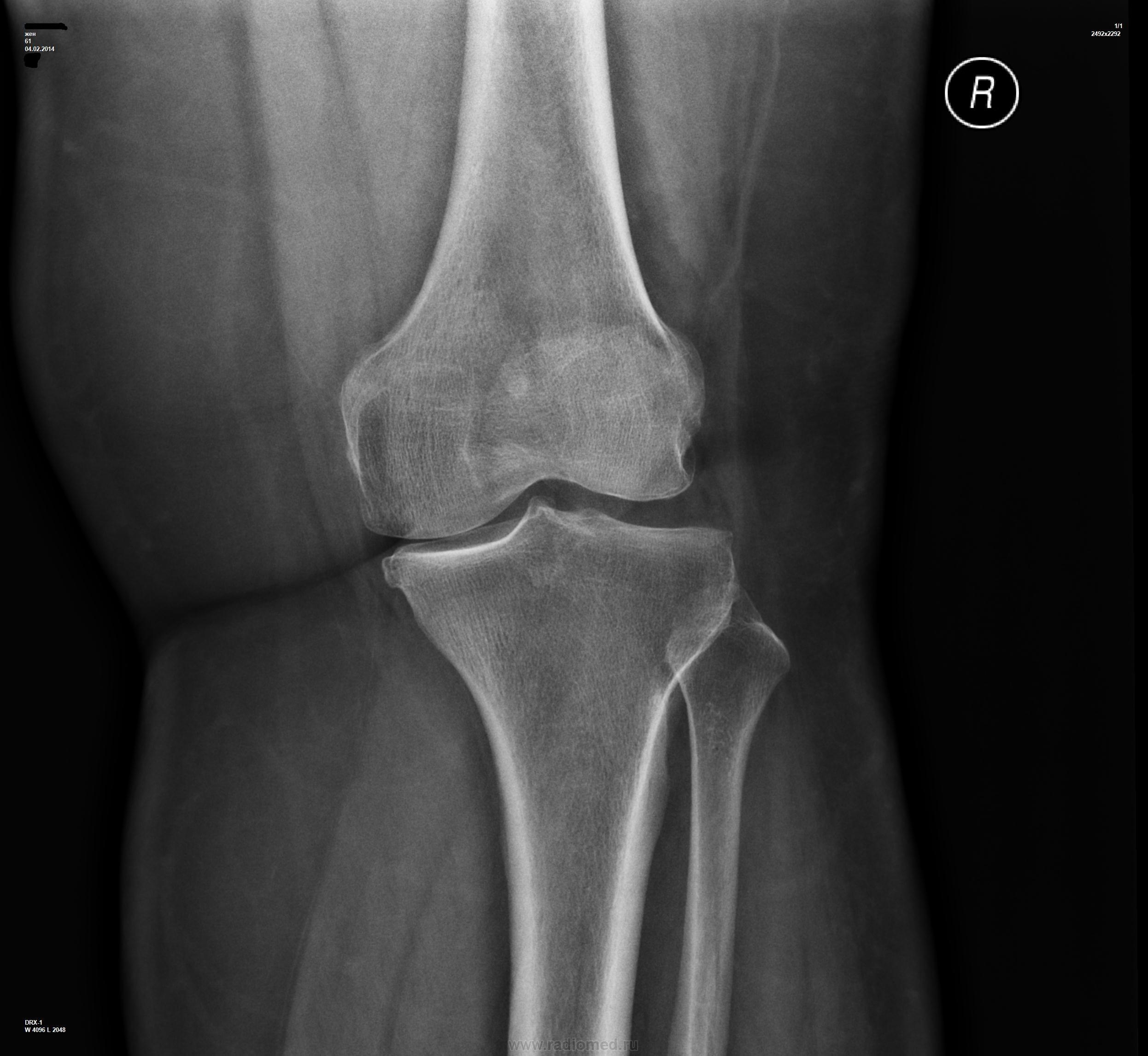 Рентген колена. ВБС левого коленного сустава рентген. Рентгенограмма коленного сустава в норме. Менисцит коленного сустава рентген. Рентгеновский снимок коленного сустава в норме.