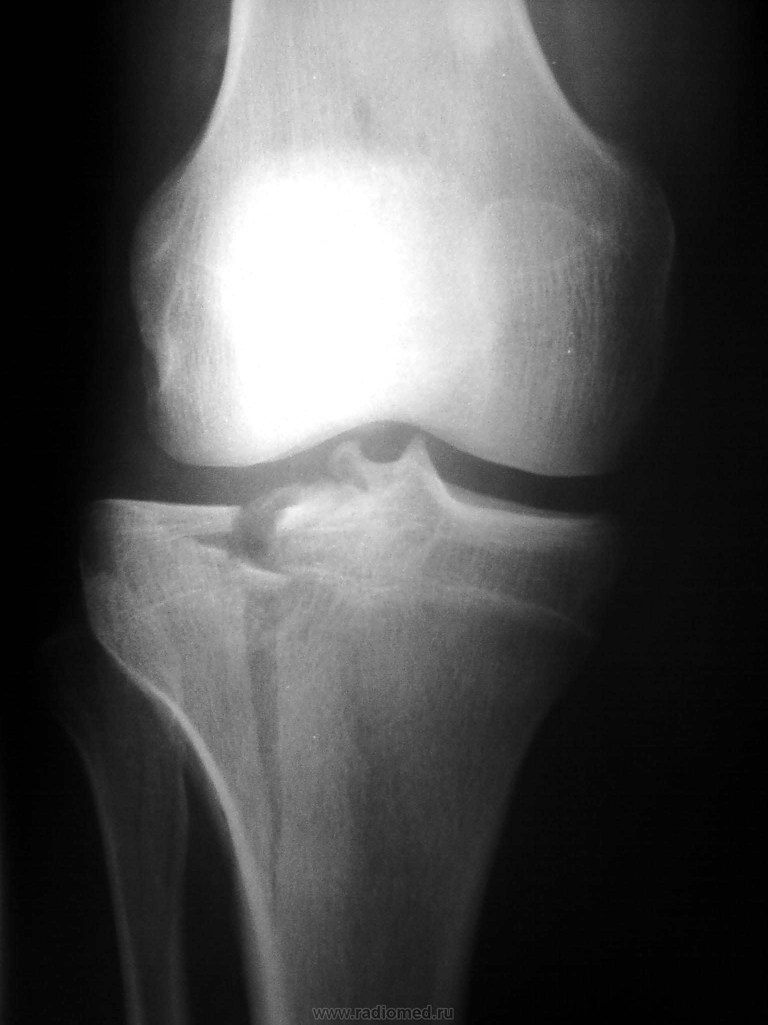 Трещина связке. Надколенник коленного сустава рентген. Коленный сустав рентген связка надколенника. Перелом коленного сустава рентгенограмма.