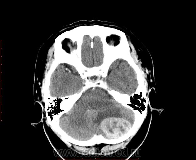 Менингиома на кт