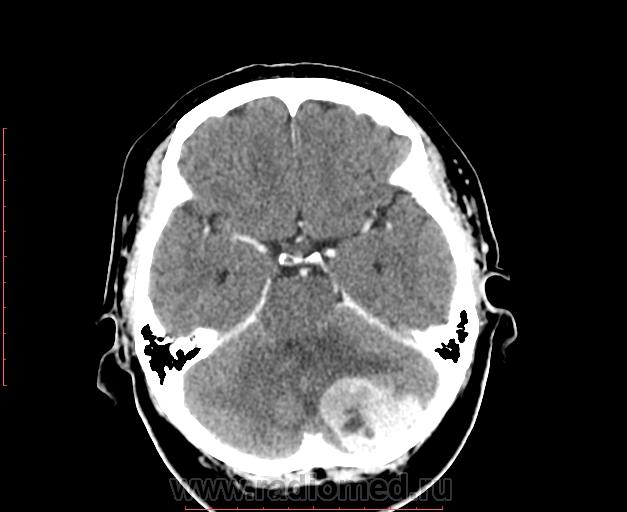 Менингиома на кт. Менингиома ГМ на кт. Петрифицированная менингиома. Петрифицированная менингиома головного мозга кт. Парасагиттальная менингиома кт.