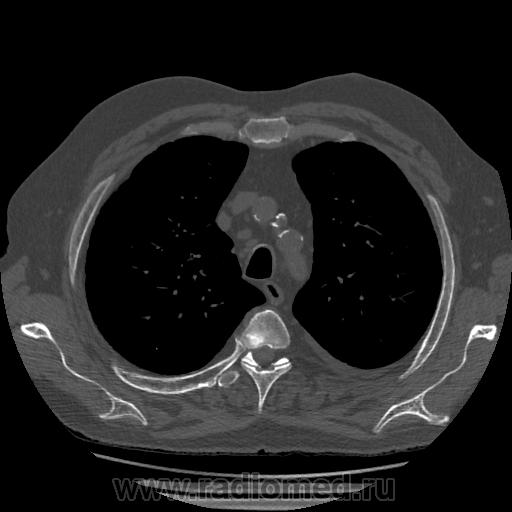Типы очагов на кт. Типы очагов на кт. Типы очагов на кт. Очаги в лёгких на кт. Симптом перстня на кт легких.