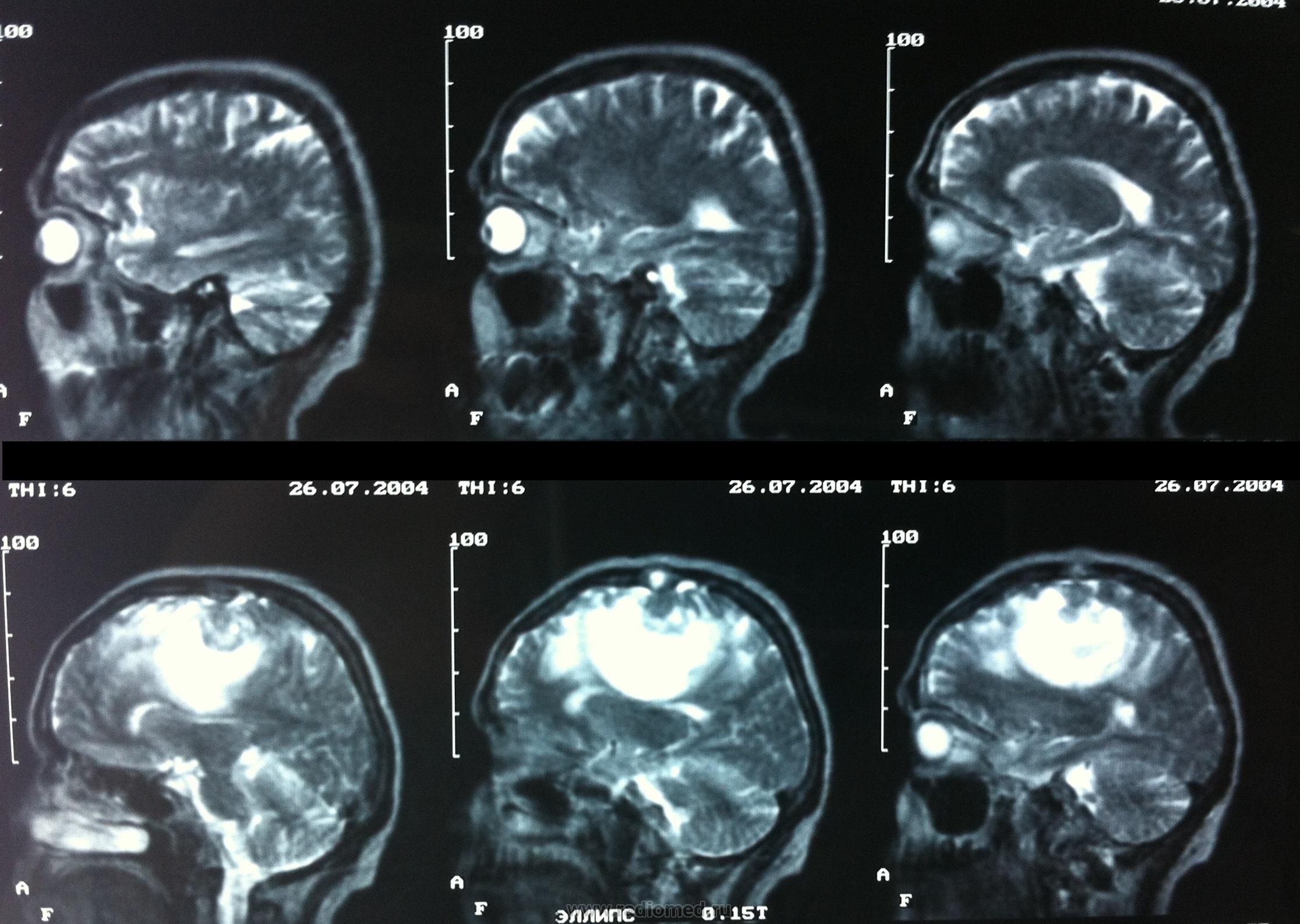 После операции менингиомы головного мозга. Менингиома кт ГМ. Менингиома лобной доли кт. Ольфакторная менингиома. КРАНИООРБИТАЛЬНАЯ опухоль головного мозга.