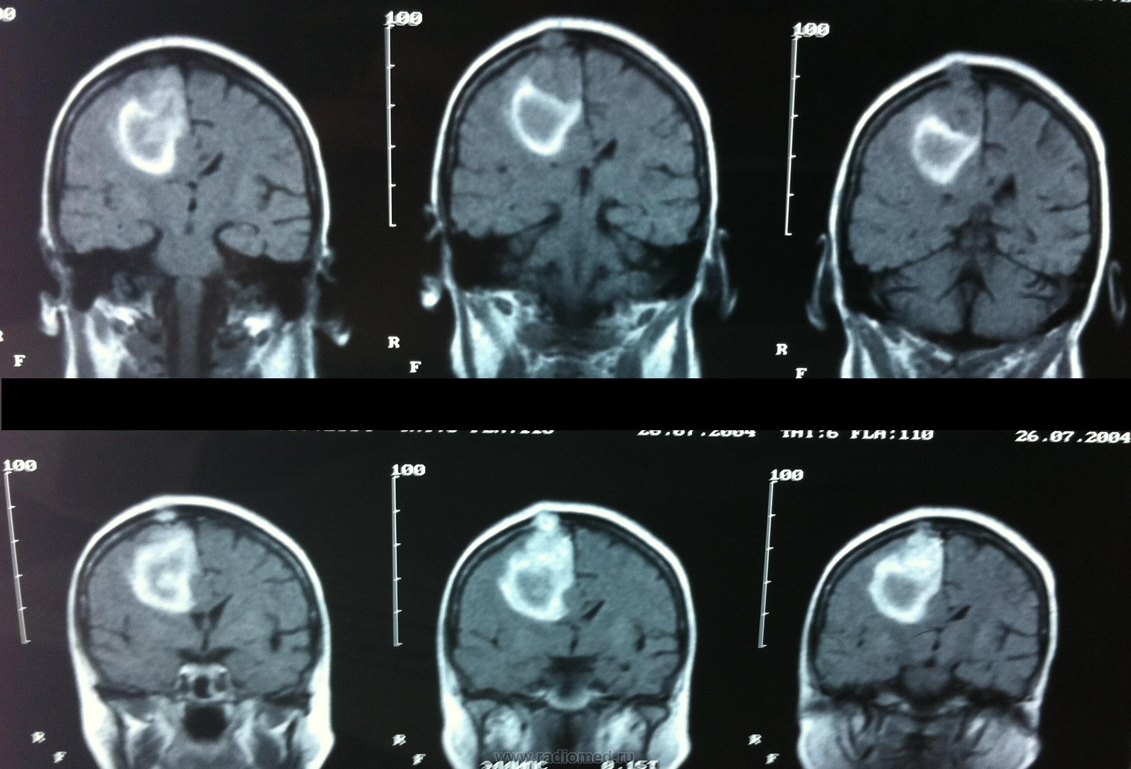 После операции менингиомы головного мозга. Фалькс менингиома кт. Менингиома доброкачественная. Фалькс менингиома головного. Менингиома лобной доли кт.