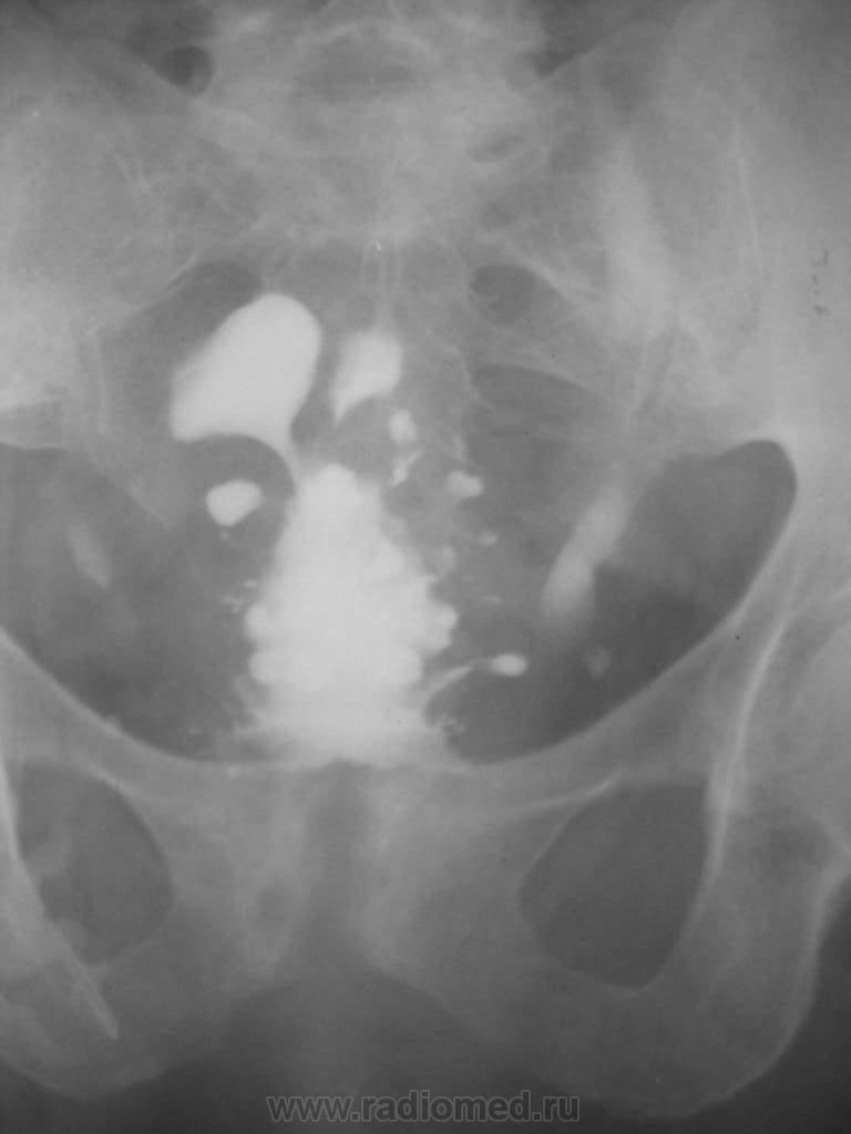 Цистография. Цистография мочевого пузыря рентген. Конкременты мочевого пузыря рентген. Экскреторная цистография.