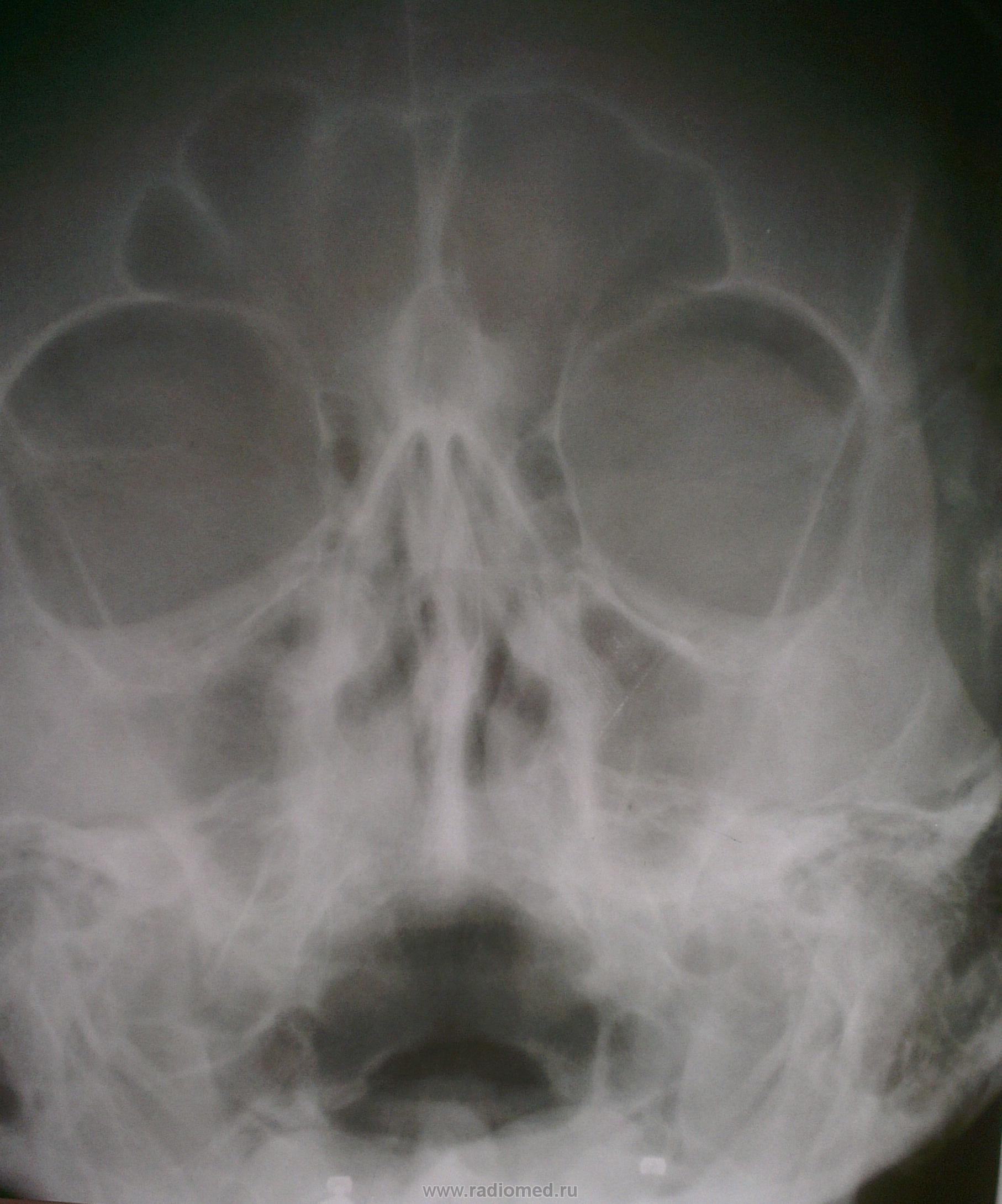 Рентген носа