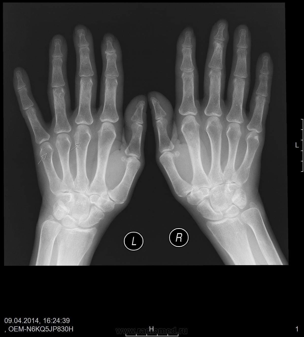 Околосуставной остеопороз кистей рук