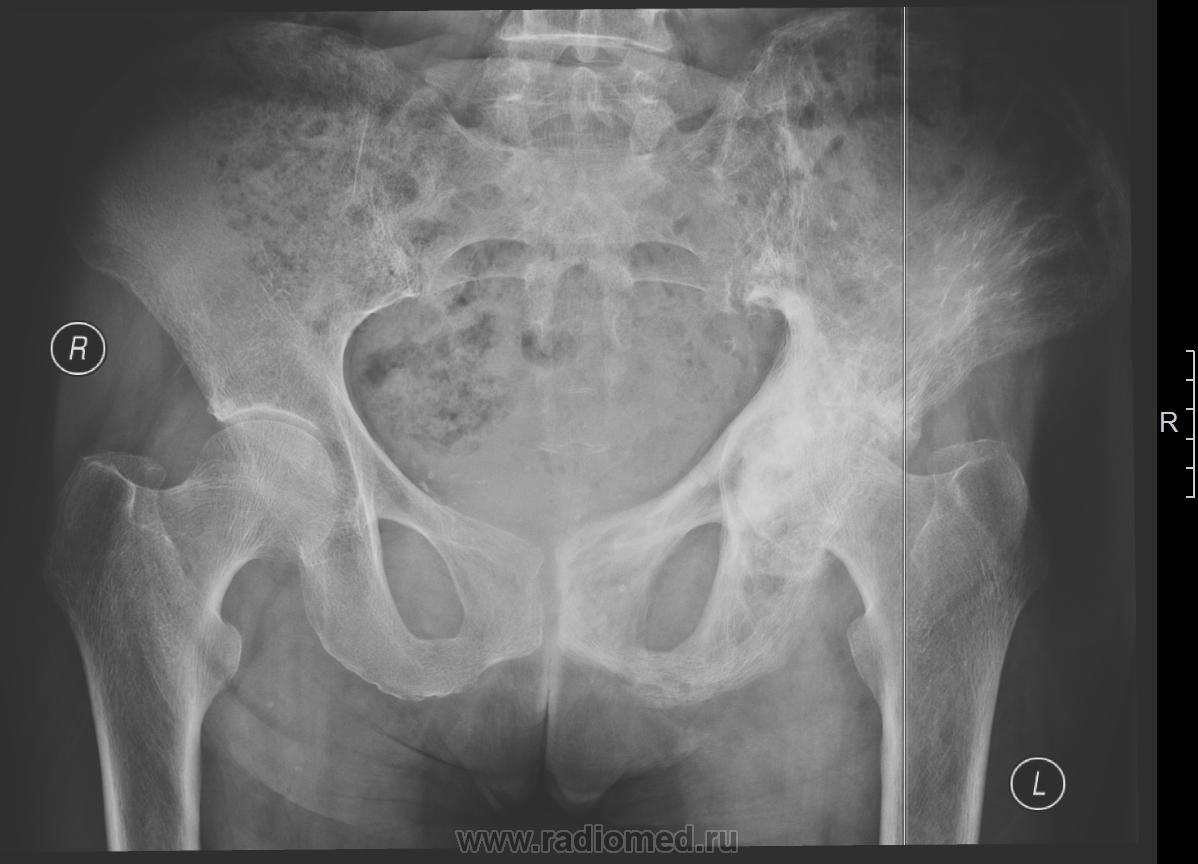 Образование подвздошной кости. Лигаментоз тазобедренного сустава рентген. Перелом подвздошной кости рентген. Остеосклеротический очаг в подвздошной кости на кт. Очаг подвздошной кости 15х13.