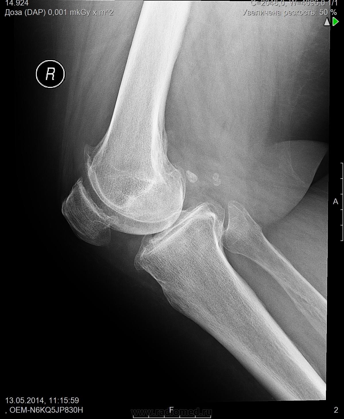 Лигаментоз крестообразных связок коленных. Хондрокальциноз коленного сустава рентген. Обызвествление связок коленного сустава на рентгене. Лигаментоз коленного сустава рентген. Обызвествления в коленном суставе на рентгене.