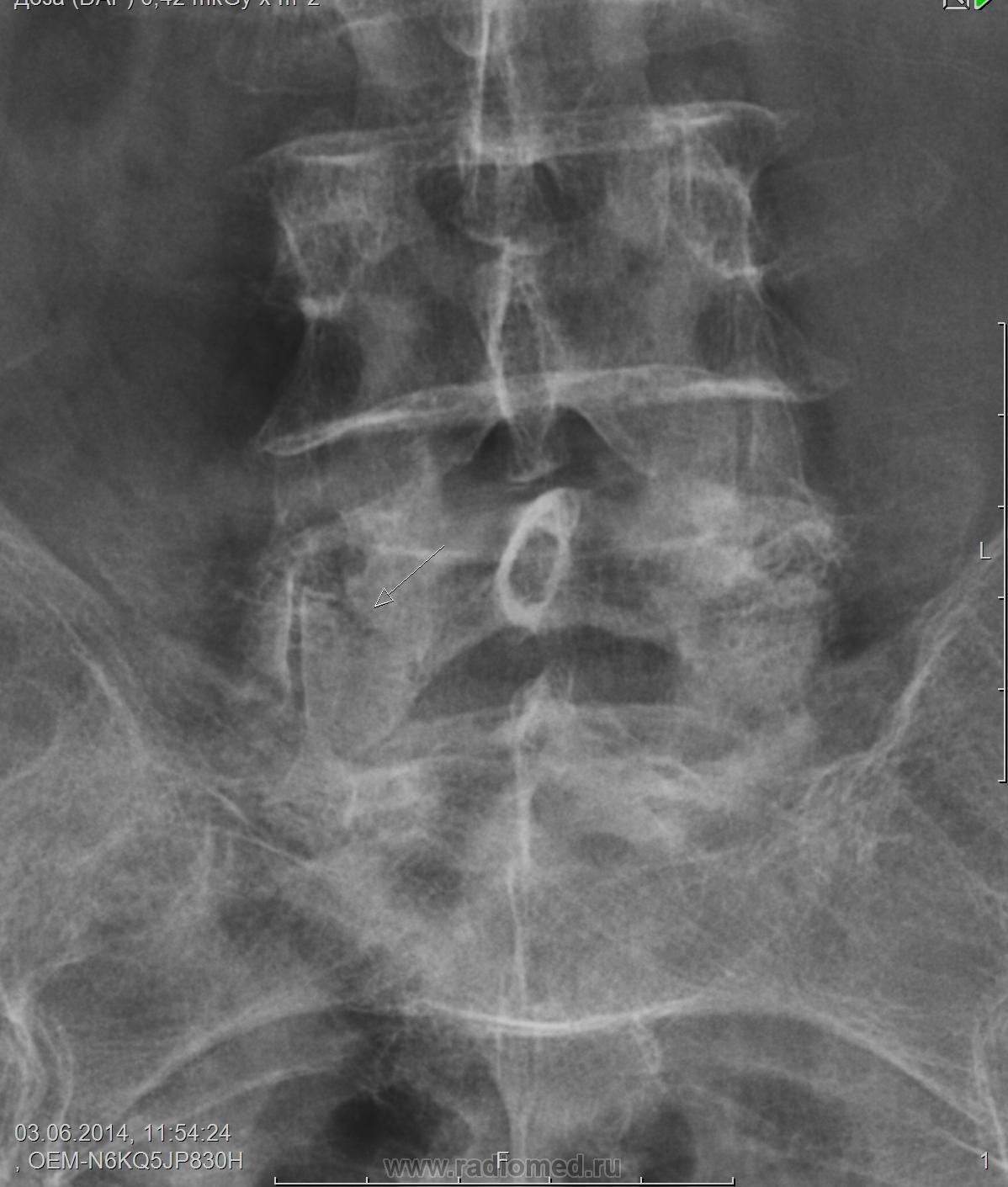 Снимок 5. Рентген патология l5. Рентген l5 норма. Перелом тела l5 рентген.