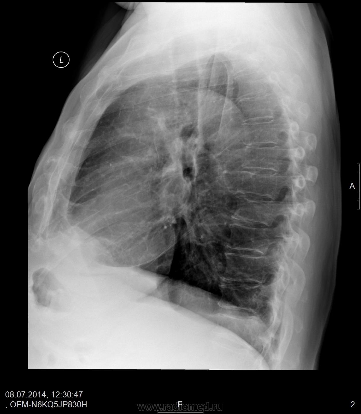 Рентген норма. Рентген ОГК боковая проекция. Рентген грудной клетки в боковой проекции норма. Рентген ОГК В боковой пр. Рентгенография ОГК В боковой проекции.