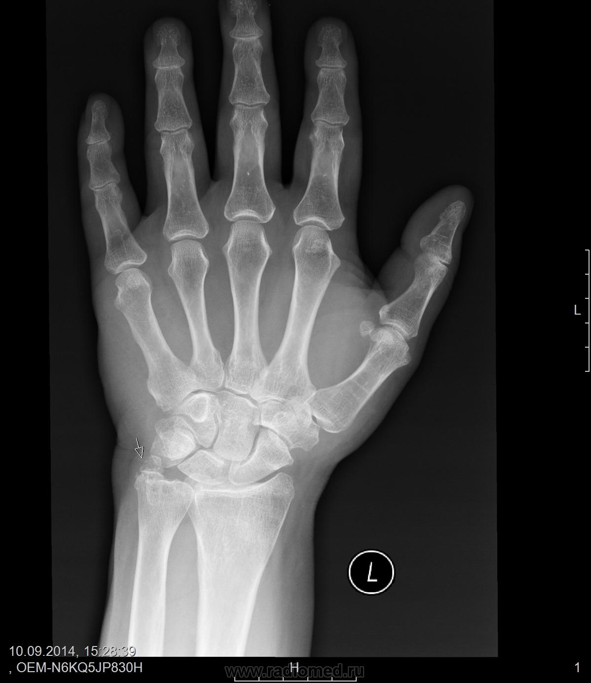 Перелом шиловидного отростка локтевой кости рентген