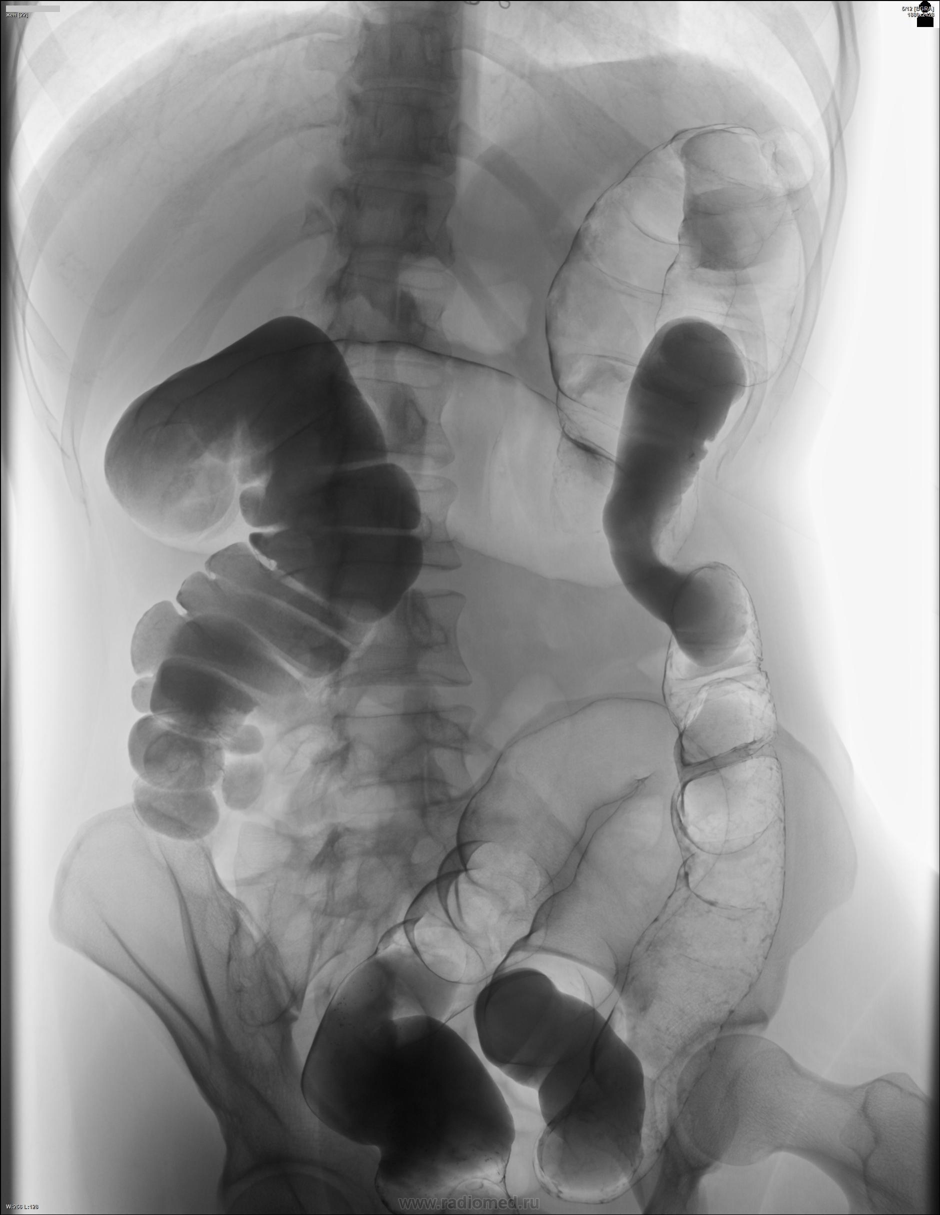Ирригоскопия фото. Кишечная непроходимость ирригоскопия. Ирригоскопия и ирригография. Ирригоскопия с сульфатом бария. Ирригоскопия патология.