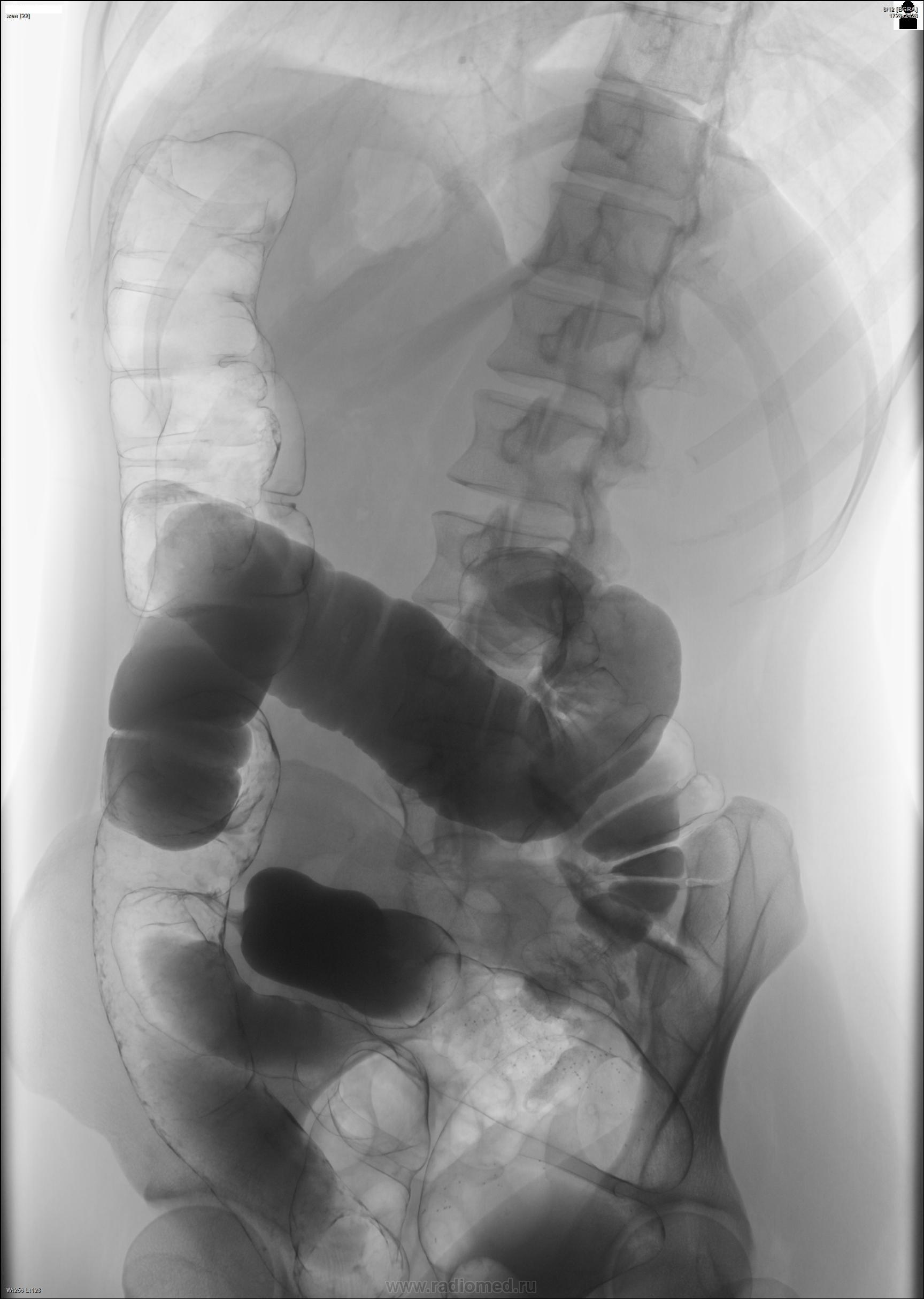Ирригоскопия почек. Колостома ирригоскопия. Ирригоскопия патология. Ирригоскопия кишечника Реал. Грыжа кишечника на рентгене.
