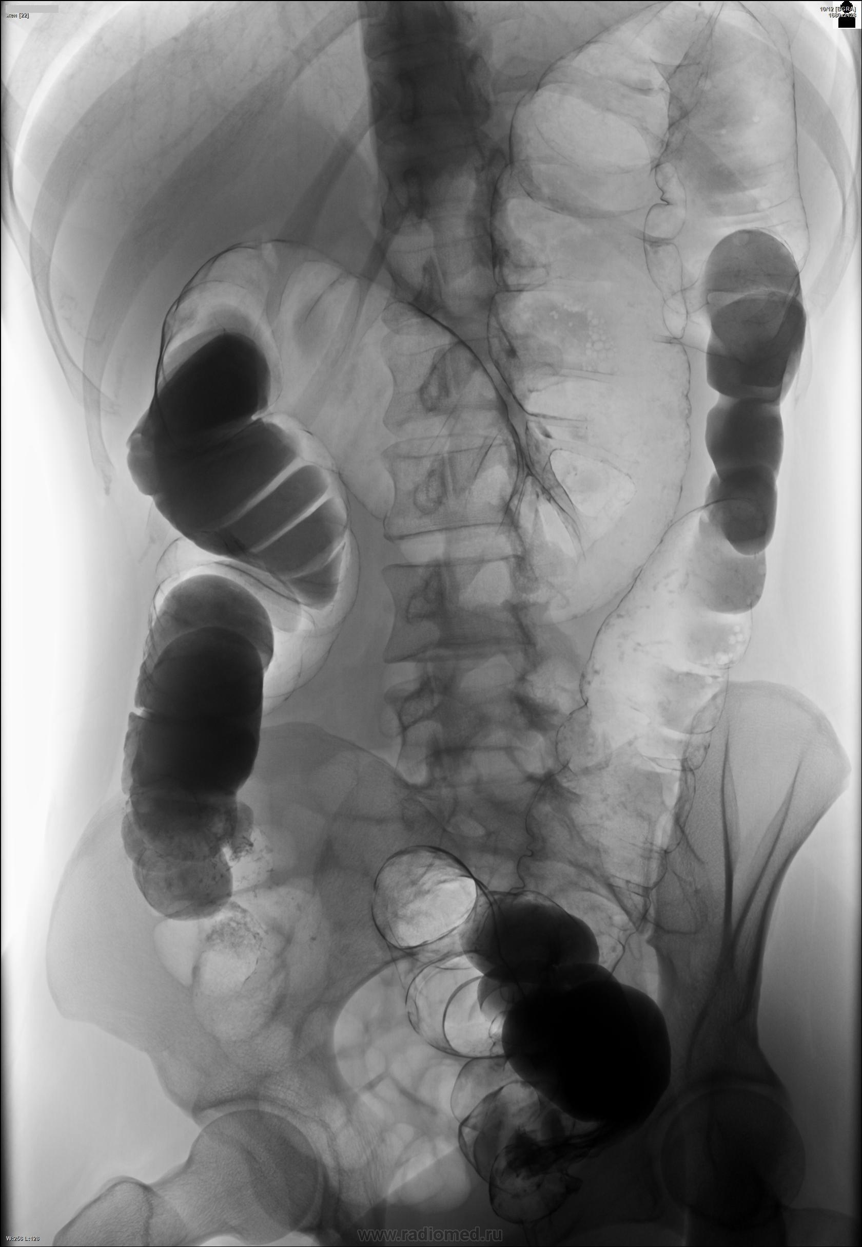 Ирригоскопия фото. Ирригография толстой кишки. Полипы кишечника рентген.