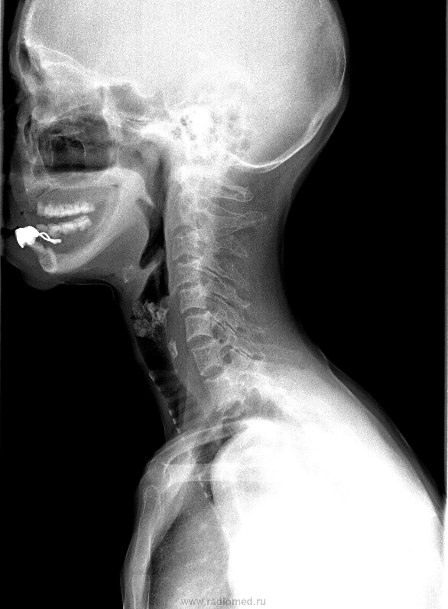 Рентгенограмма глотки