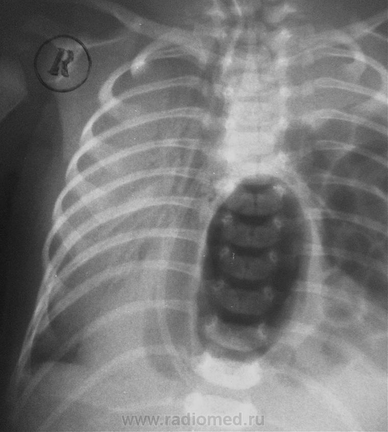 Рентген грудному ребенку. Пневмомедиастинум у новорожденных рентген. РДС новорожденных рентген. ОРДС У новорожденных рентген. Рентгенограмма пневмопатия.