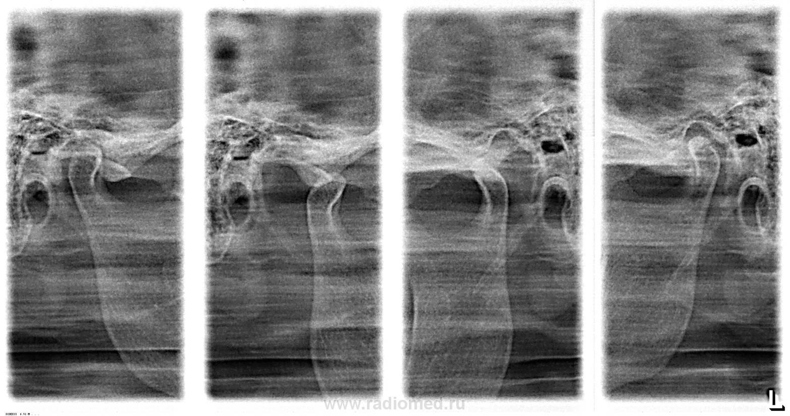 Рентгенологическая картина при хронических артритах височно нижнечелюстного сустава
