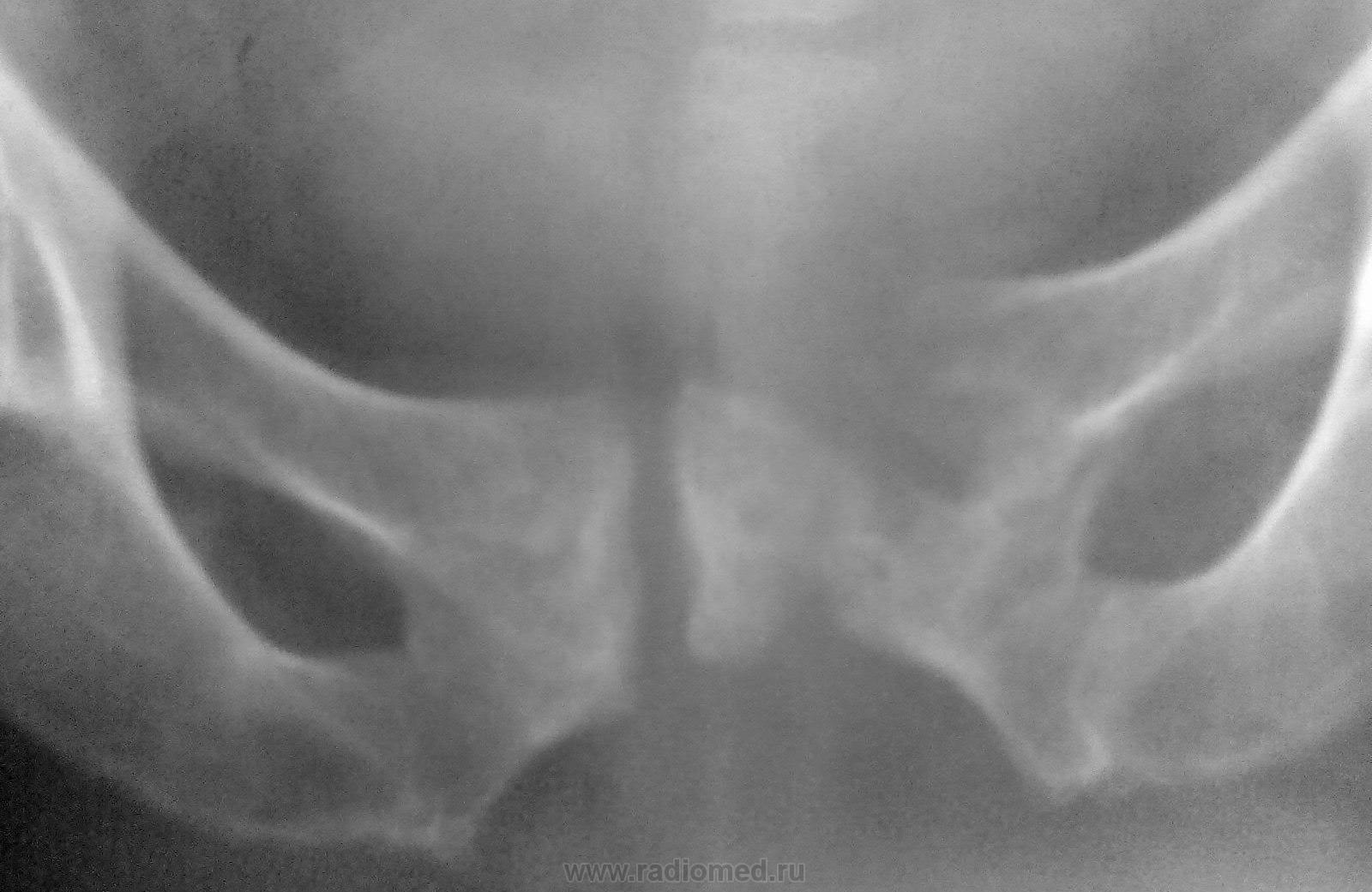 Кости таза переломы рентгенография боковая