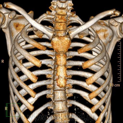 Полом ребра. Кт ребер грудной клетки.
