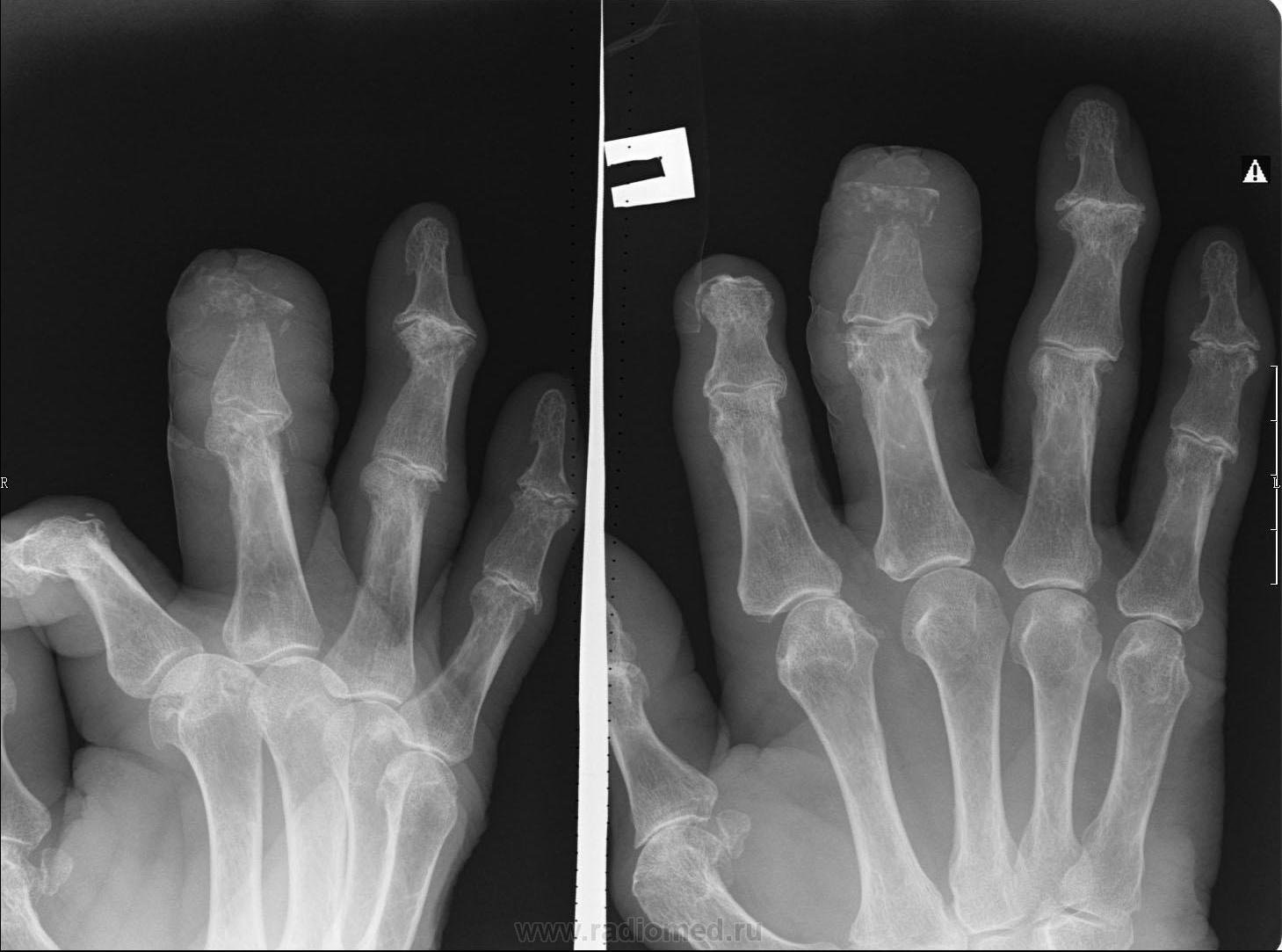 Трещина фаланги. Остеомиелит кисти рентген. Остеомиелит фаланги кисти рентген. Мкб перелом ногтевой фаланги пальца кисти. Остеомиелит кости на рентгене палец руки.