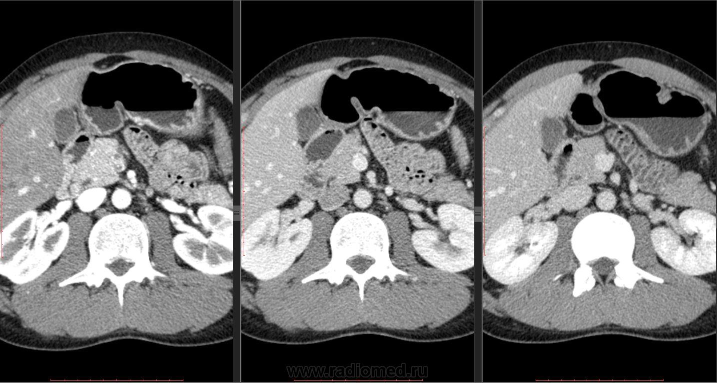Кт картина острого панкреатита
