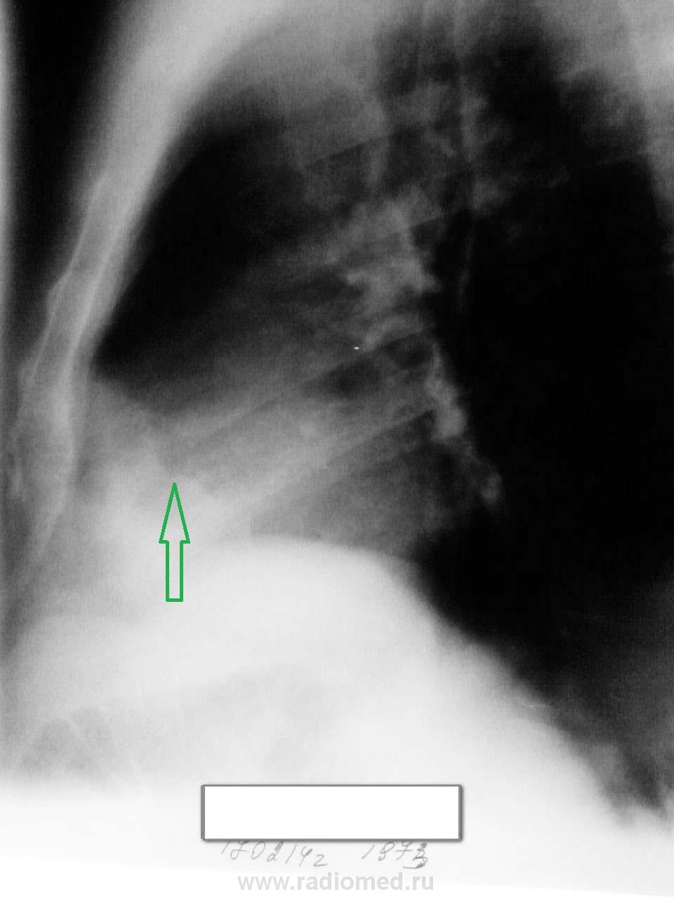 Кардиодиафрагмальный синус. Липома кардиодиафрагмального угла справа кт. Парастернальная липома кардиодиафрагмального угла. Кардиодиафрагмальный синус рентген. Липома кардиодиафрагмального синуса рентген.