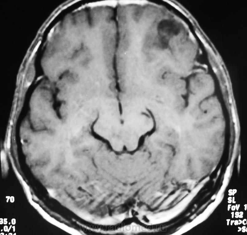 Показывает ли кт опухоль мозга. Рецидив опухоли головного мозга. Рецидив опухоли мозга мрт. Рецидив опухоли головного мозга через 8 лет. Мрт прошлого.