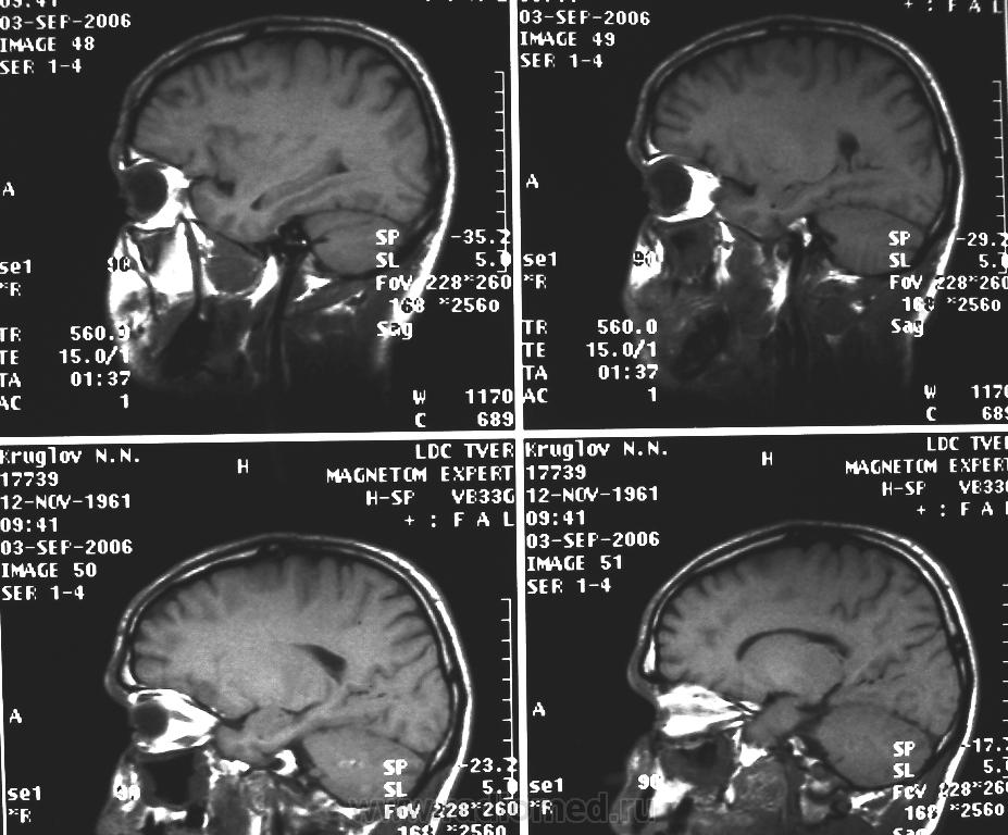 Показывает ли кт опухоль мозга. Опухоль головного мозга на кт. Анализы на опухоль мозга. Кт показало опухоль в голове.