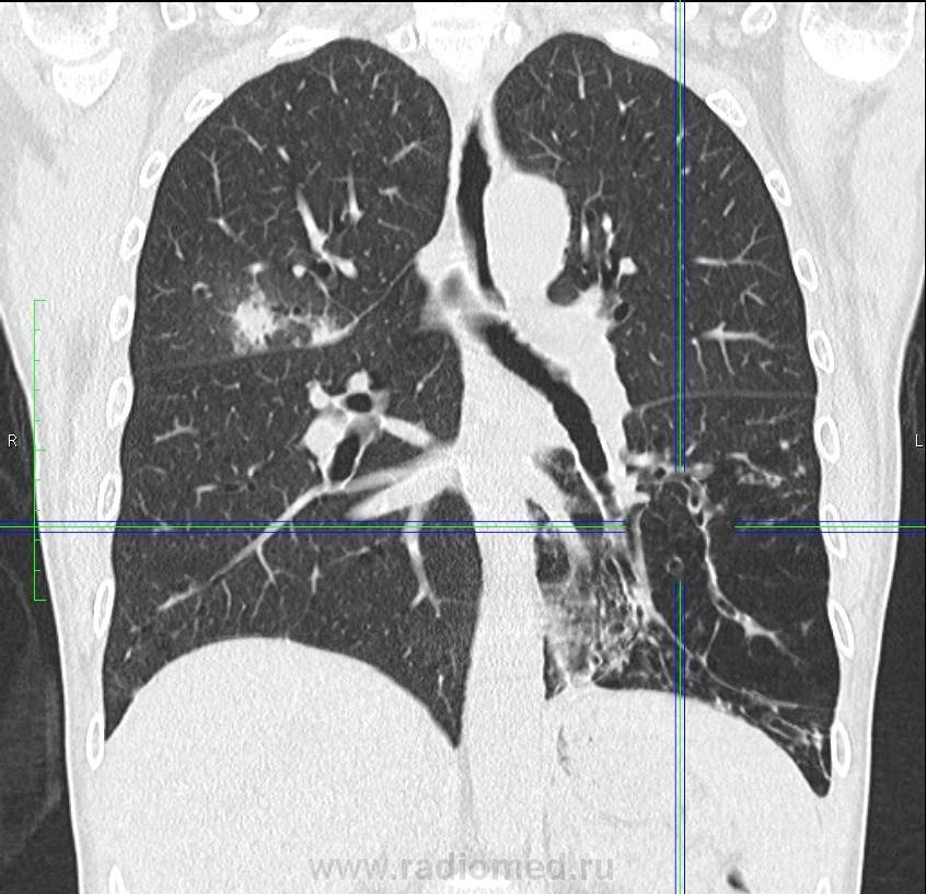 Компьютерная томография грудной клетки. Томограмма грудной клетки. Кт органов грудной клетки (легкие и органы средостения). Пневмония на мрт грудной клетки. Снимок МСКТ грудной клетки.