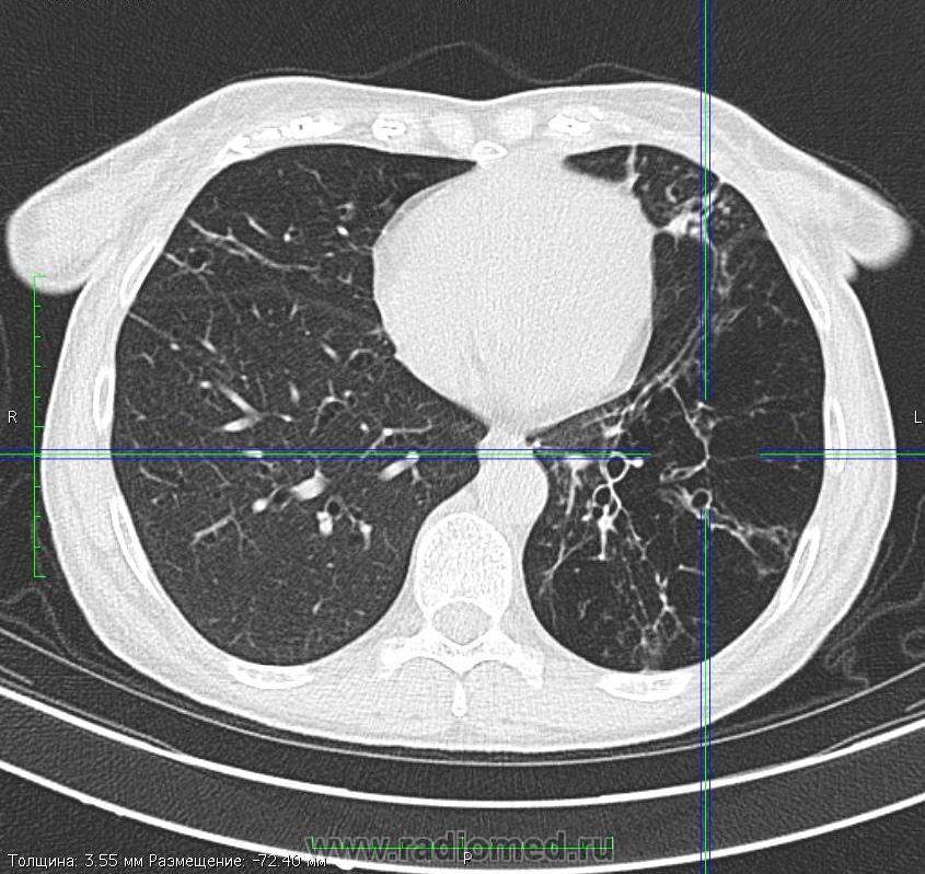 Компьютерная томография грудной клетки