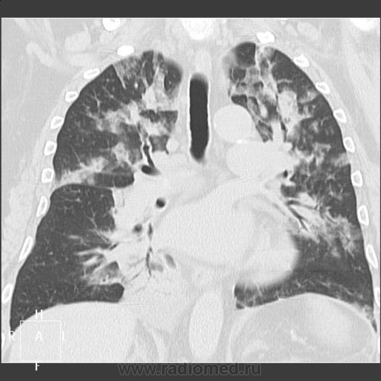 Хламидийная пневмония рентгенологическая картина
