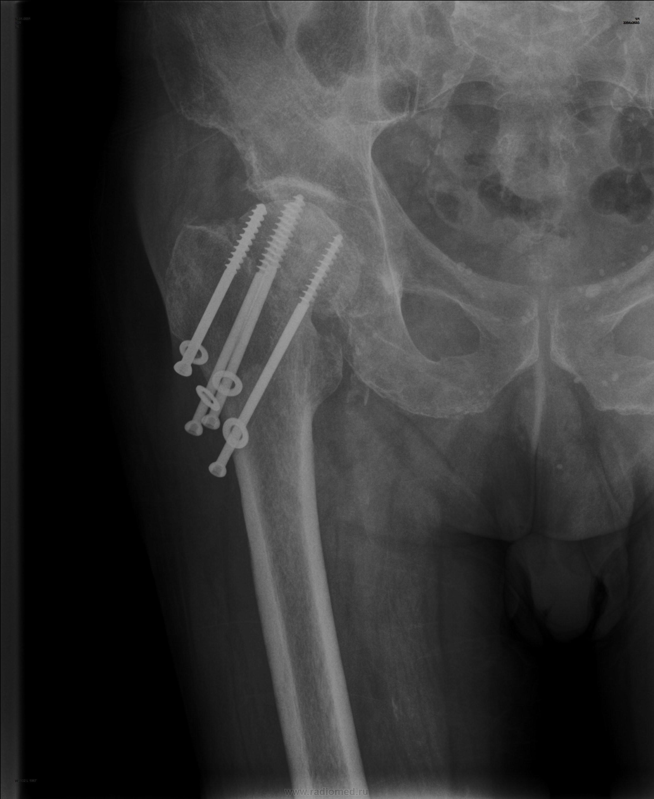 Операция тазобедренный кость. Перелом шейки бедра остеосинтез рентген. Остеосинтез шейки бедра рентген. Перелом шейки бедра снимок рентгенограммы. Перелом шейки бедра рентгенограмма.