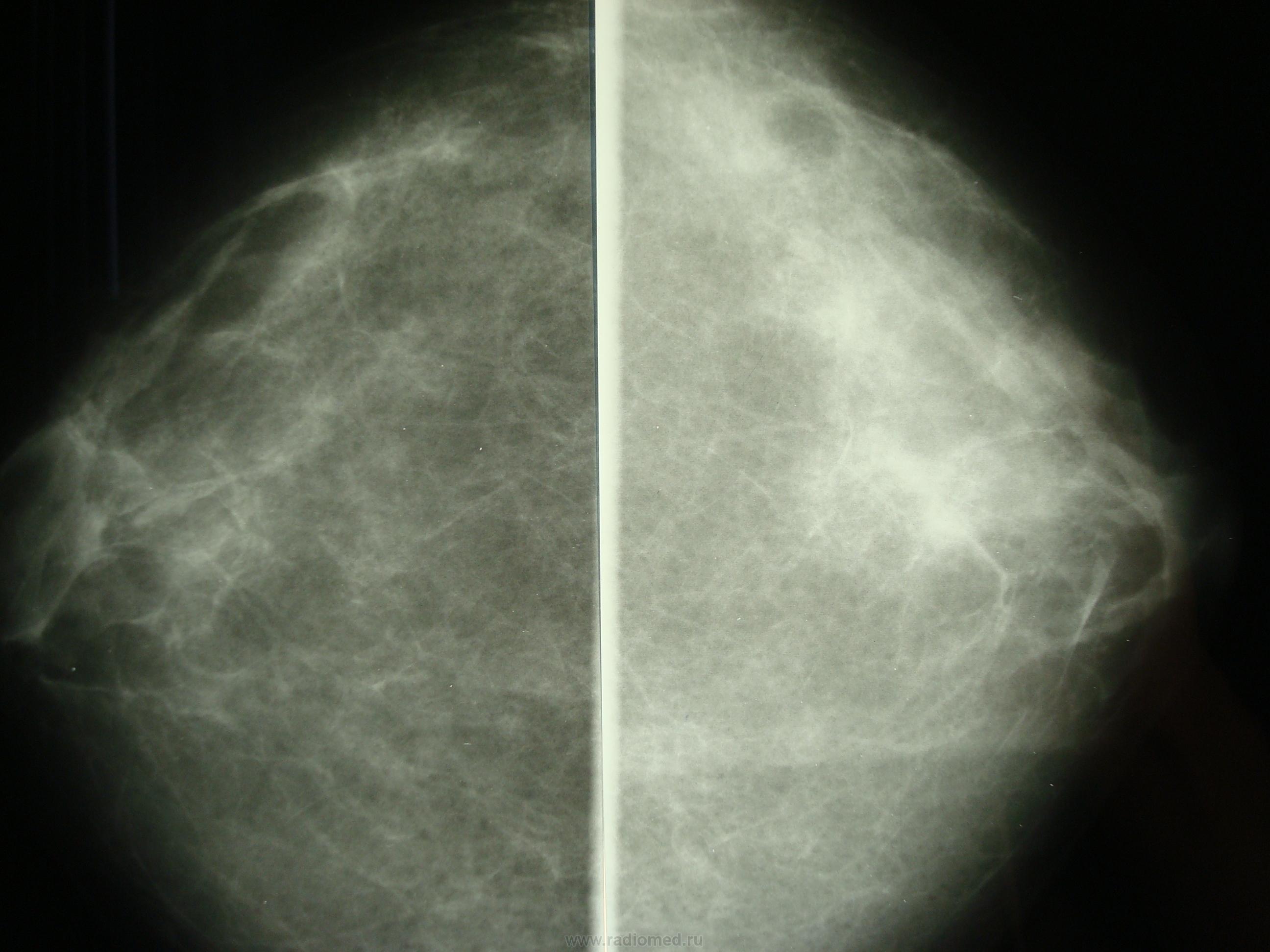 Маммография старый. Тепловизорная маммография. Снимки маммографии молочных желез в норме. Маммография рентген снимки. Фиброаденома молочной железы маммография.