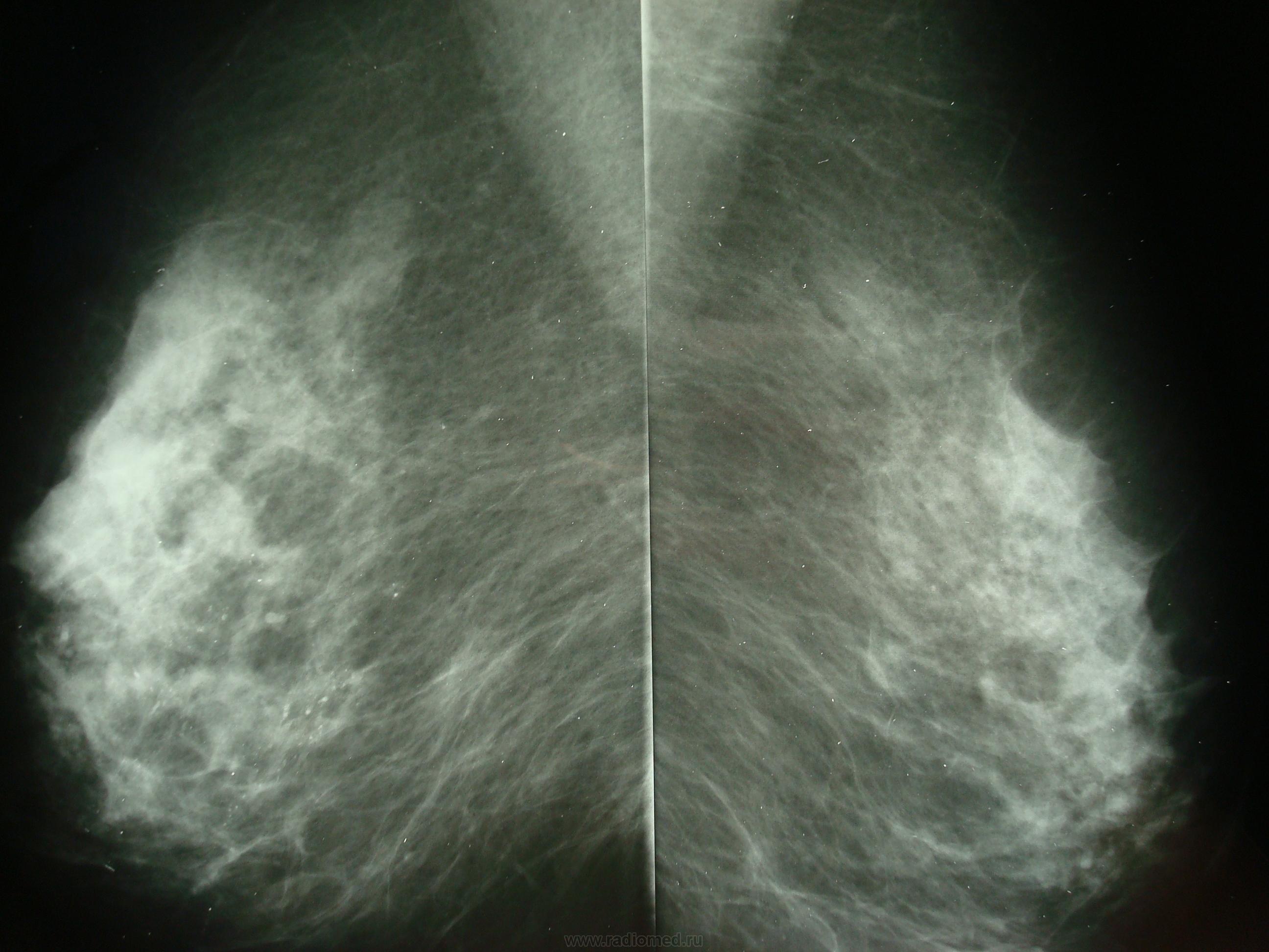 Bl rads 2. Маммография. Здоровый снимок маммографии. Симптом мышиного хвоста на маммографии.