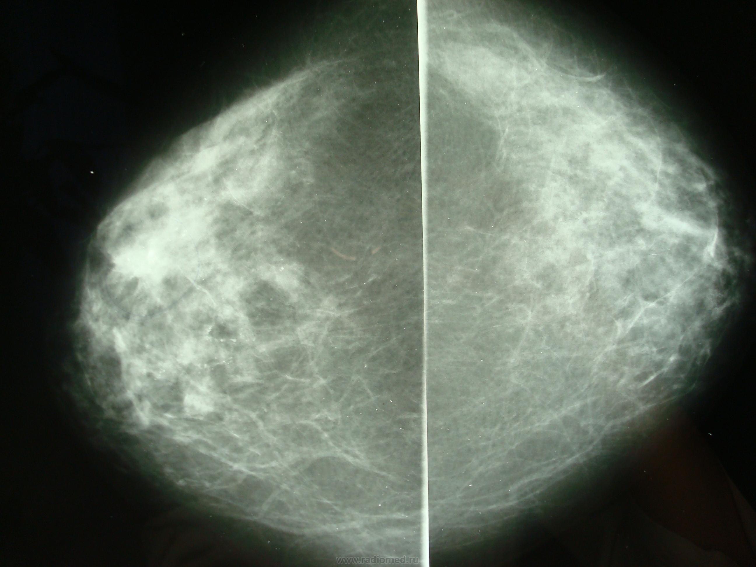 Маммография старый. Малоинформативная маммография. Маммография (1 молочная железа 2 проекции ). Мастопатия молочной железы маммограмма.
