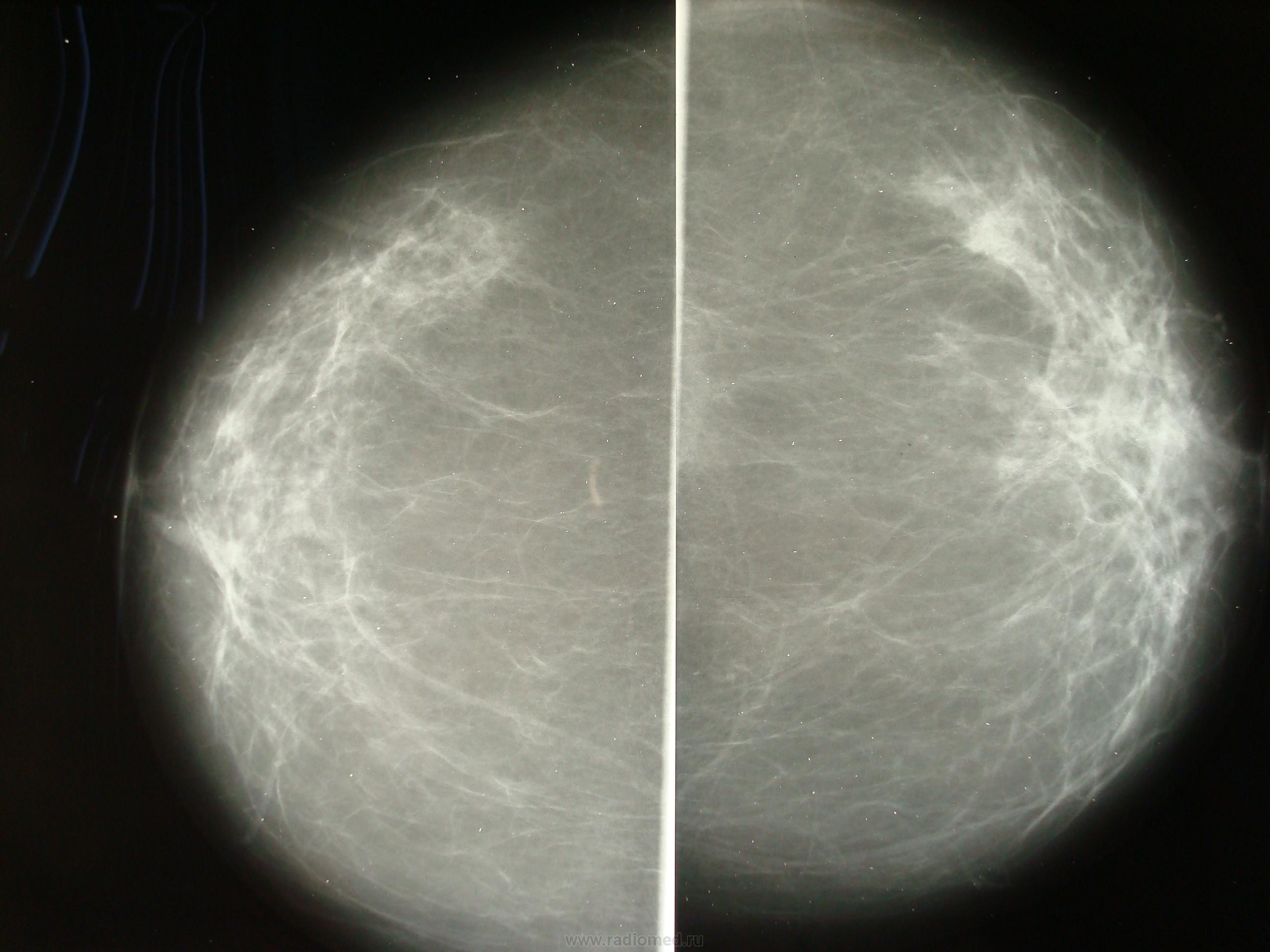 как делают маммографию груди у женщин фото 101