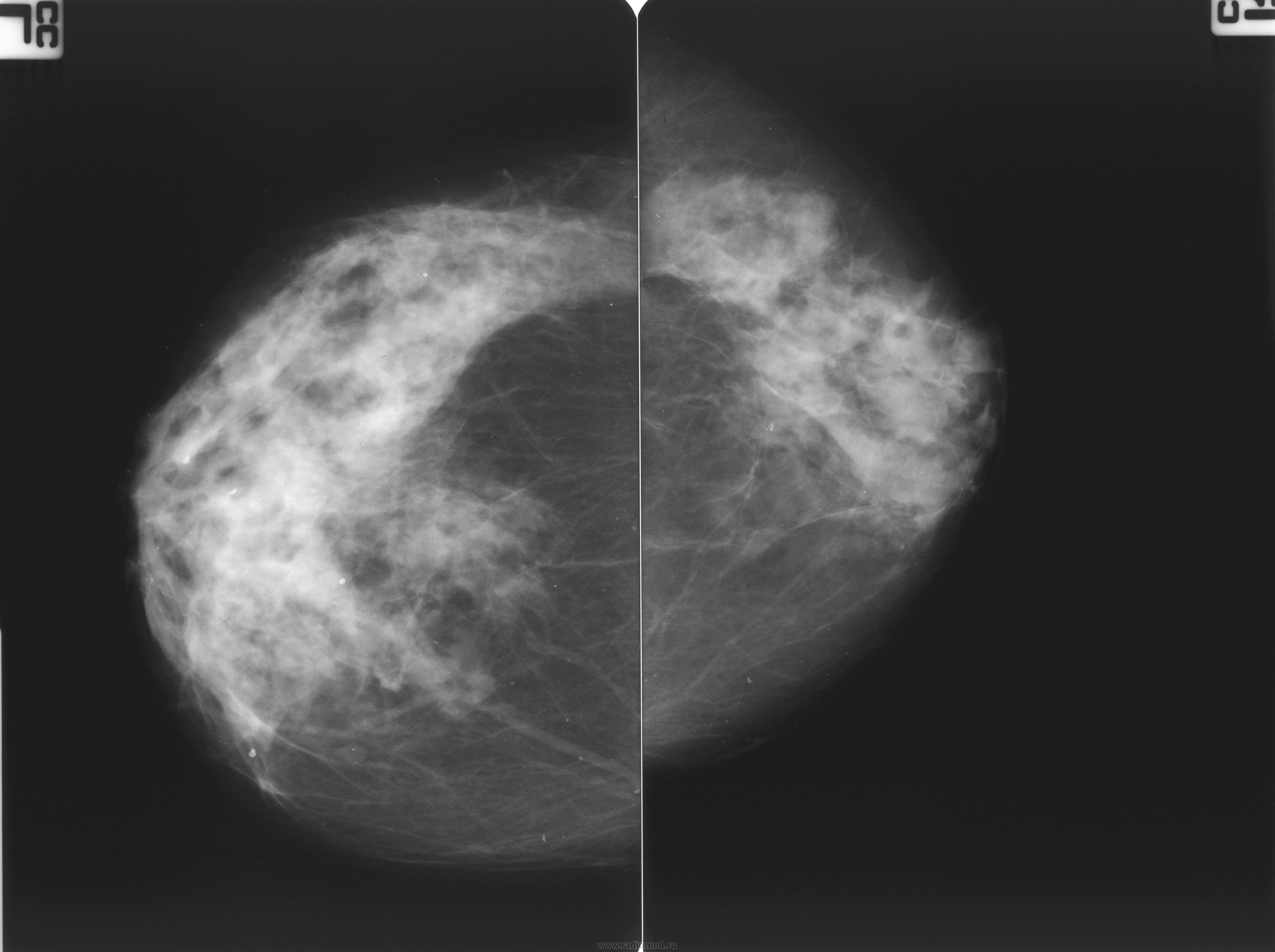 Липома молочной железы маммограмма