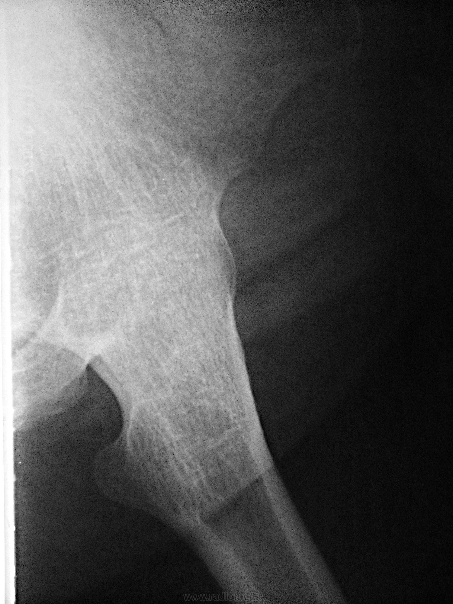 Анкилоз это. Костный анкилоз на рентгене. Анкилоз тазобедренного сустава рентген. Анкилоз сустава рентген.