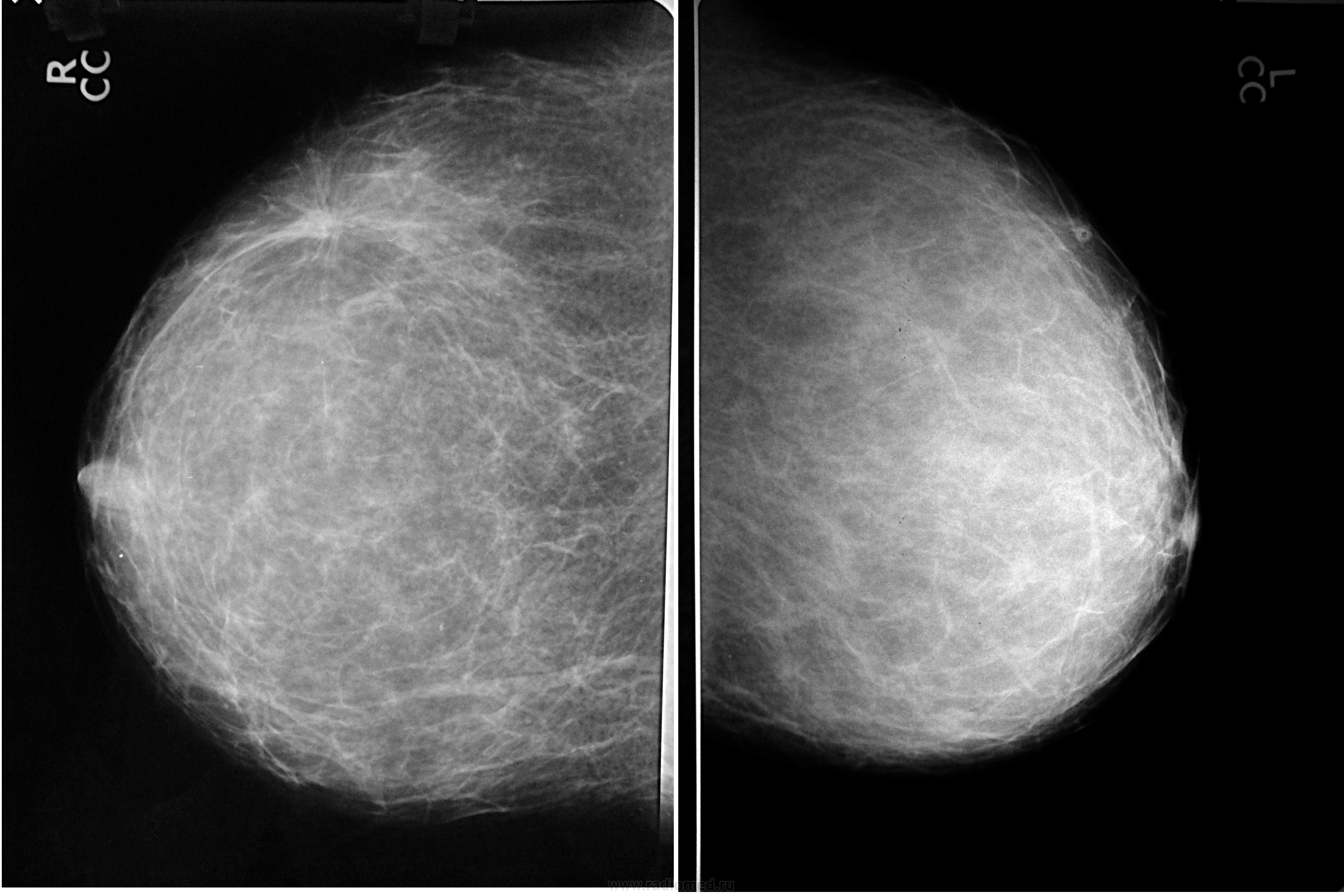 Маммография старый. Маммография рентген молочной железы. Маммография молочных желез РМЖ. Узловая мастопатия на маммографии. Маммография рентгеновские снимки.