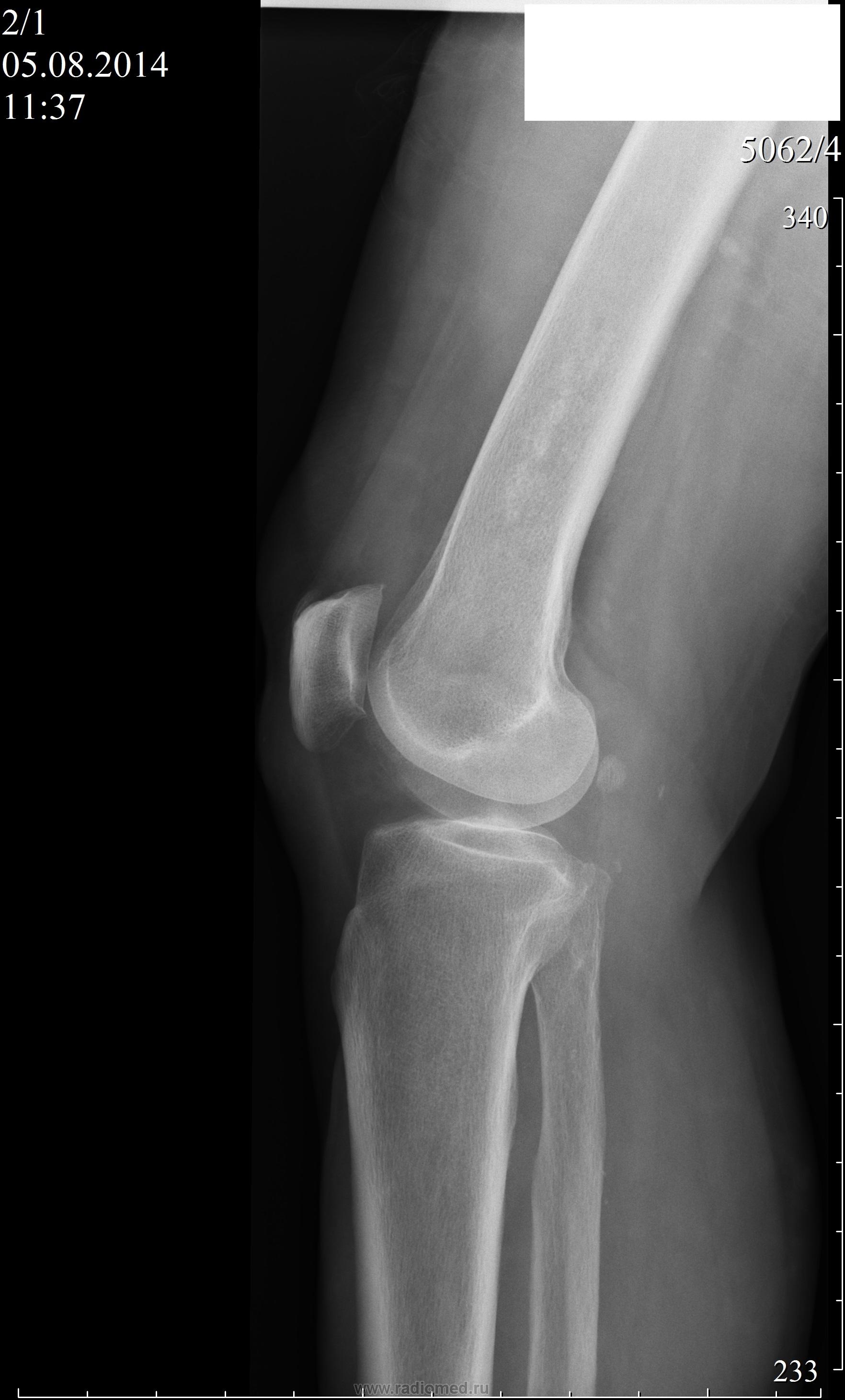 Рентген колена. Синовиома коленного сустава рентген. Остеопойкилия коленного сустава рентген. Рентген коленного сустава в двух проекциях. Рентген коленного сустава с функциональными пробами.