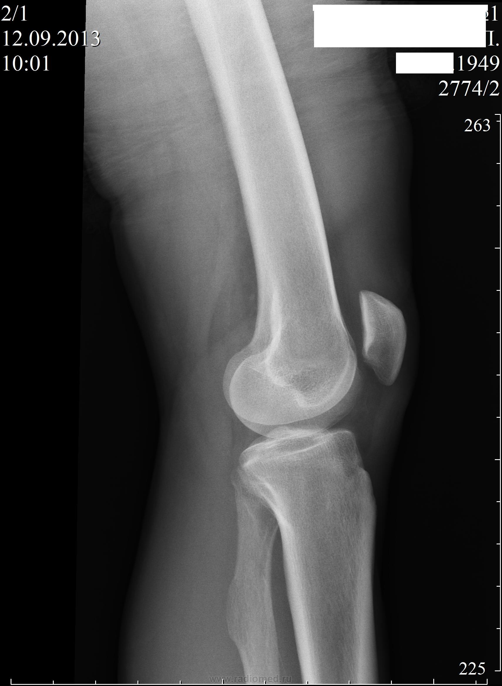 Проекции рентгена коленного сустава. Рентген коленного сустава в боковой проекции. Рентген колена боковая проекция. Рентген коленного сустава сбоку. Флеболит коленного сустава.