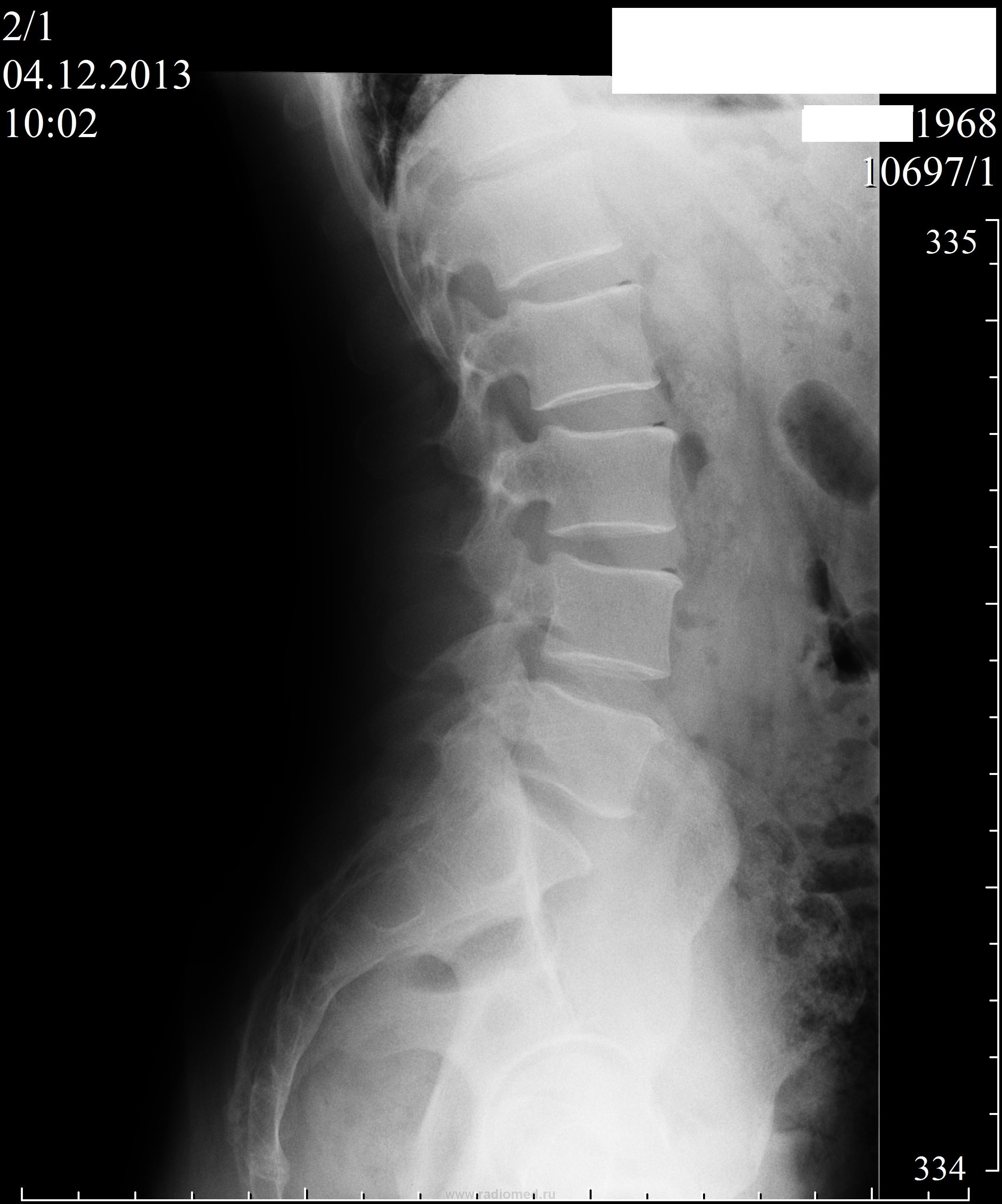 Пояснично крестцовый отдел позвоночника фото рентген