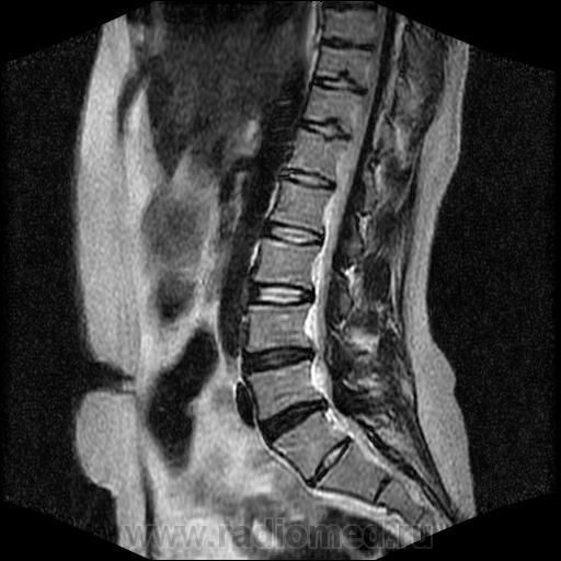 Спондилоартроз пояснично крестцового. Спондилоартроз пояснично-крестцового l4-s1 l5. Спондилоартроз l3-s1. Спондилоартроз th12-s1. Спондилоартроз пояснично-крестцового мрт.