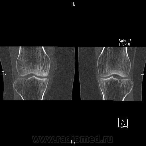 Некроз мыщелков. Асептический некроз коленного кт. Асептический некроз коленного сустава рентген. Асептический некроз мыщелка бедренной кости кт. Асептический некроз коленного сустава кт.