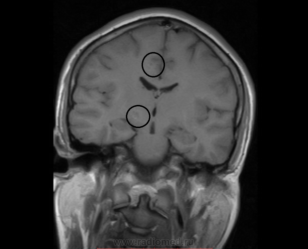 Очаговые изменения головного мозга
