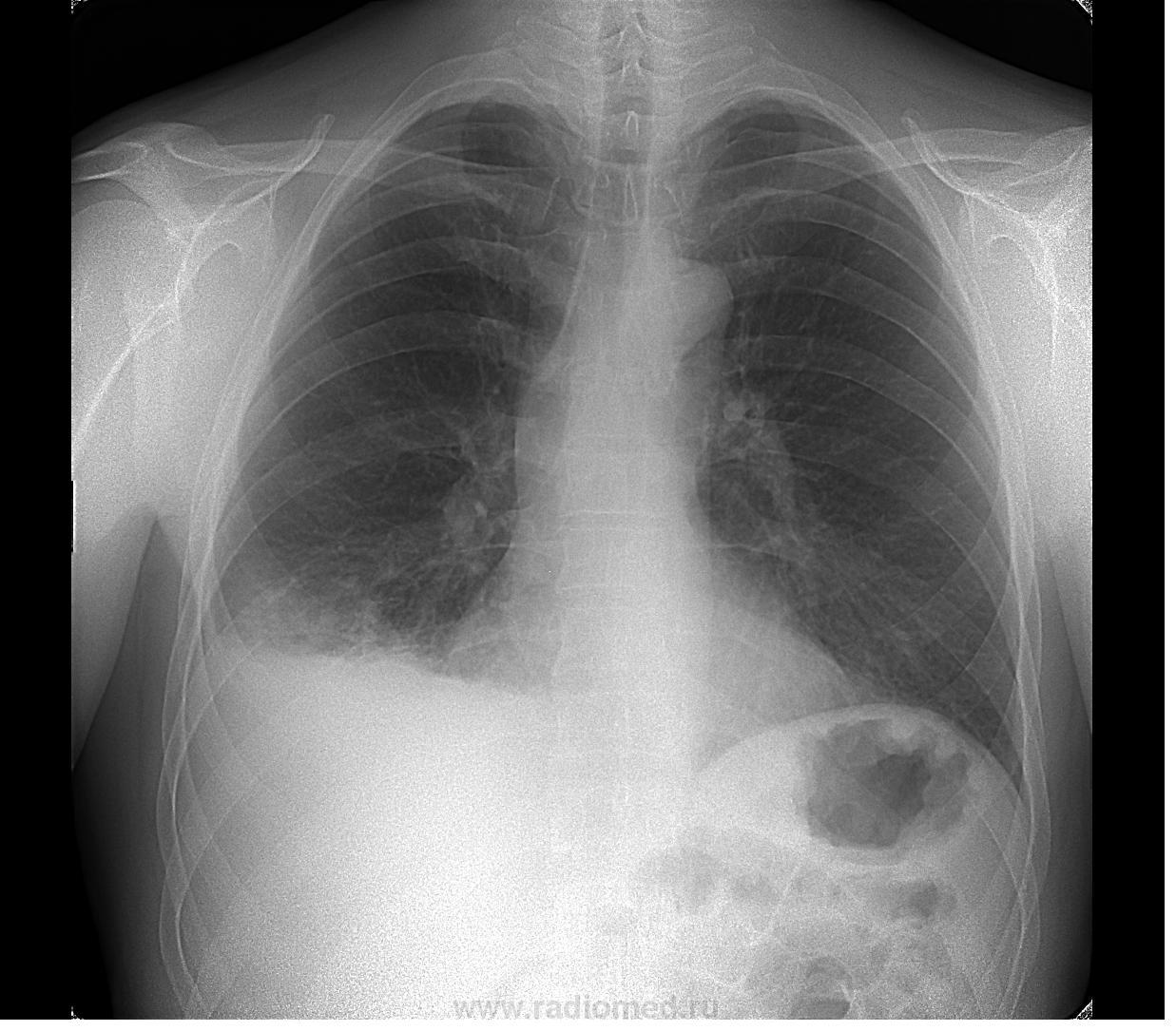 Внутриутробная пневмония рентген