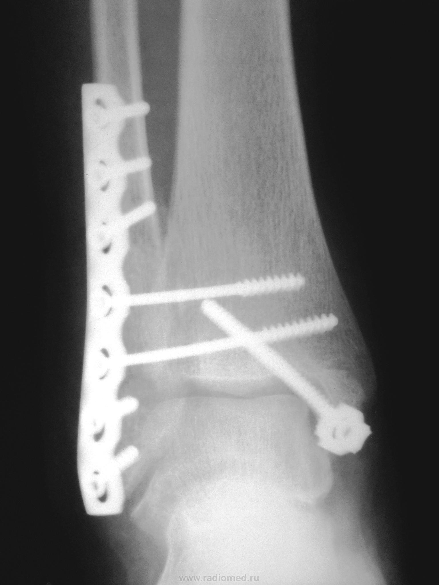 Пластина после перелома ноги. Остеосинтез двухлодыжечный перелом. Внутрикостный остеосинтез лодыжки. Перелом лодыжки с остеосинтезом. Остеосинтез лодыжки пластиной рентген.